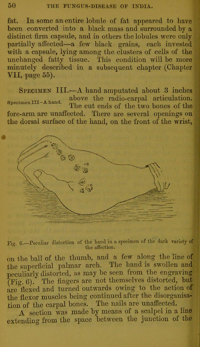 fat. In some an entire lobule of fat appeared to have been converted into a black mass and surrounded by a distinct firm capsule, and in others the lobules were only partially affected—a few black grains, each invested with a capsule, lying among the clusters of cells of the unchanged fatty tissue. This condition will be more minutely described in a subsequent chapter (Chapter VII, page 55). Specimen III.—A hand amputated about 3 inches ^ above the radio-carpal articulation. Specimen III-A nana. i i? ii I i r 1.1 Ihe cut ends oi the two bones ot the fore-arm are unaffected. There are several openings on the dorsal surface of the hand, on the front of the wrist, 6—Peculiar distortion of the hand in a specimen of the dark variety ° the affection. on the ball of the thumb, and a few along the line oi the superficial palmar arch. The hand is swollen and peculiarly distorted, as may be seen from the engraving (rig. 6). The fingers are not themselves distorted, but are'^flexed and turned outwards owing to the action of the flexor muscles being continued after the disorganisa- tion of the carpal bones. The nails are unaffected. A section was made by means of a scalpel in a line extending from the space between the junction of the