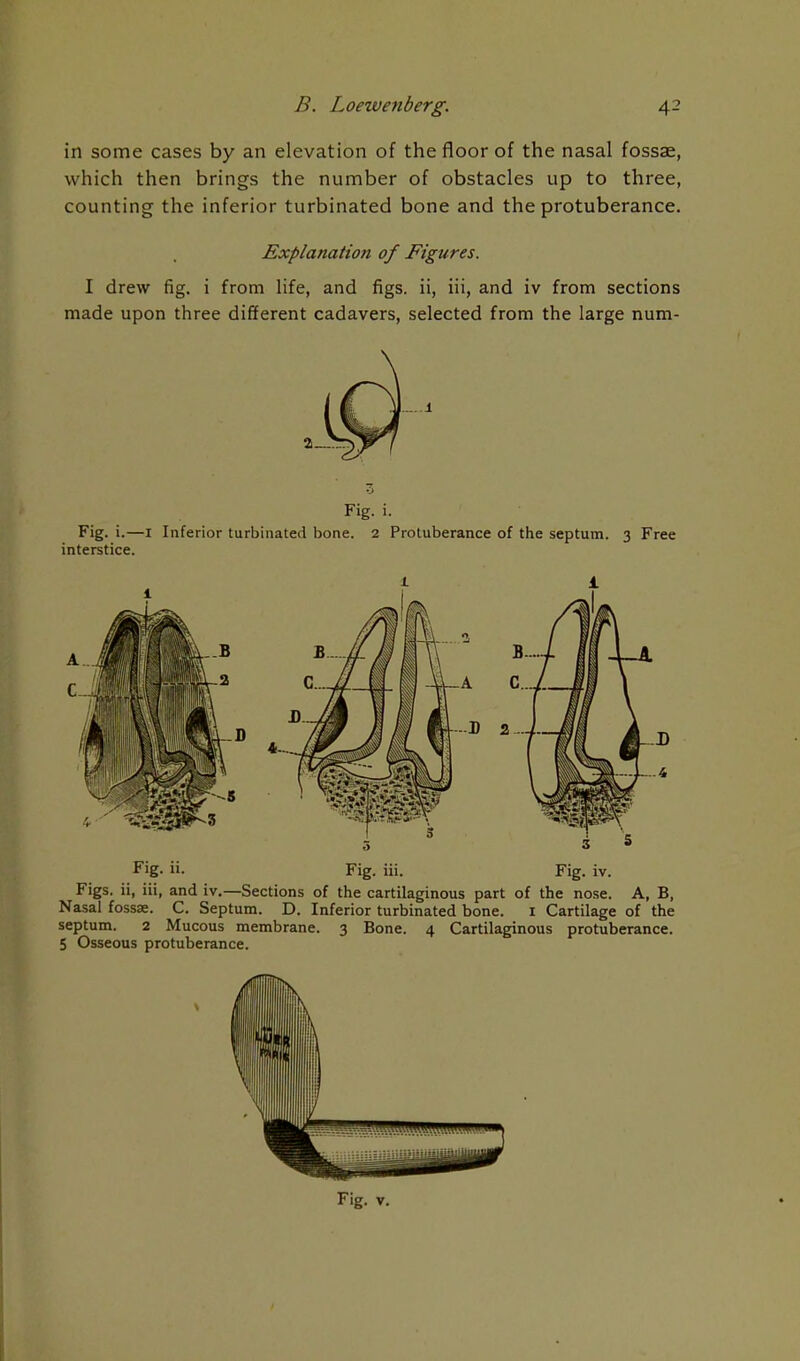 in some cases by an elevation of the floor of the nasal fossae, which then brings the number of obstacles up to three, counting the inferior turbinated bone and the protuberance. Explanation of Figures. I drew fig. i from life, and figs, ii, iii, and iv from sections made upon three different cadavers, selected from the large num- Fig. i. Fig. i.—I Inferior turbinated bone. 2 Protuberance of the septum. 3 Free interstice. Fig. ii. Fig. iii. Fig. iv. Figs, ii, iii, and iv.—Sections of the cartilaginous part of the nose. A, B, Nasal fossae. C. Septum. D. Inferior turbinated bone. i Cartilage of the septum. 2 Mucous membrane. 3 Bone. 4 Cartilaginous protuberance. 5 Osseous protuberance. Fig. V.