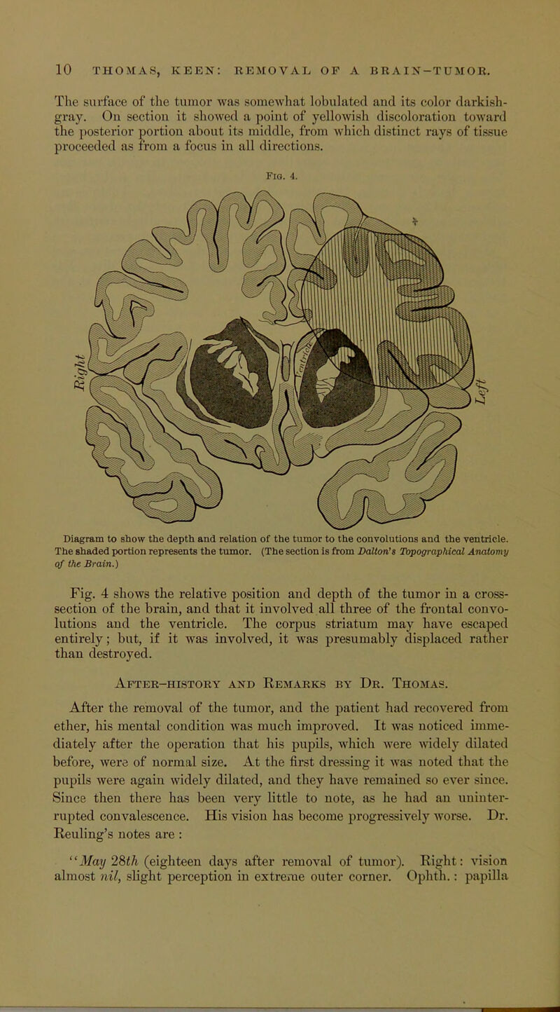 The surface of the tumor was somewhat tabulated and its color darkish- gray. On section it showed a point of yellowish discoloration toward the posterior portion about its middle, from which distinct rays of tissue proceeded as from a focus in all directions. Fig. 4. Diagram to show the depth and relation of the tumor to the convolutions and the ventricle. The shaded portion represents the tumor. (The section is from Dalton's Topographical Anatomy of the Brain.) Fig. 4 shows the relative position and depth of the tumor in a cross- section of the brain, and that it involved all three of the frontal convo- lutions and the ventricle. The corpus striatum may have escaped entirely; but, if it was involved, it was presumably displaced rather than destroyed. After-history and Remarks by Dr. Thomas. After the removal of the tumor, and the patient had recovered from ether, his mental condition was much improved. It was noticed imme- diately after the operation that his pupils, which were widely dilated before, were of normal size. At the first dressing it was noted that the pupils were again widely dilated, and they have remained so ever since. Since then there has been very little to note, as he had an uninter- rupted convalescence. His vision has become progressively worse. Dr. Reuling's notes are : May 28th (eighteen days after removal of tumor). Right: vision almost nil, slight perception in extreme outer corner. Ophth.: papilla