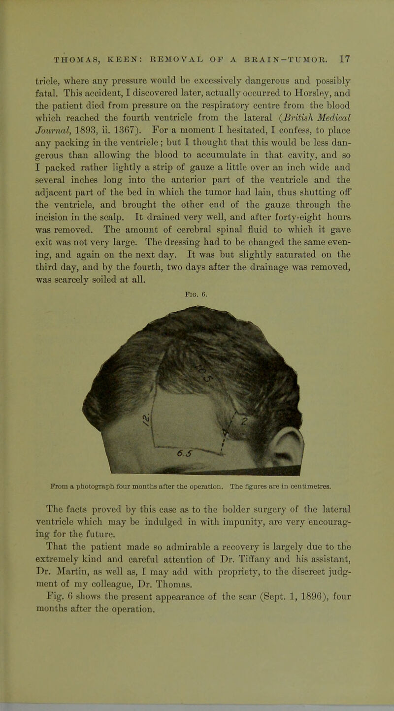 tricle, where any pressure would be excessively dangerous and possibly fatal. This accident, I discovered later, actually occurred to Horsley, and the patient died from pressure on the respiratory centre from the blood which reached the fourth ventricle from the lateral (British Medical Journal, 1893, ii. 1367). For a moment I hesitated, I confess, to place any packing in the ventricle; but I thought that this would be less dan- gerous than allowing the blood to accumulate in that cavity, and so I packed rather lightly a strip of gauze a little over an inch wide and several inches long into the anterior part of the ventricle and the adjacent part of the bed in which the tumor had lain, thus shutting off the ventricle, and brought the other end of the gauze through the incision in the scalp. It drained very well, and after forty-eight hours was removed. The amount of cerebral spinal fluid to which it gave exit was not very large. The dressing had to be changed the same even- ing, and again on the next day. It was but slightly saturated on the third day, and by the fourth, two days after the drainage was removed, was scarcely soiled at all. fig. 6. From a photograph four months after the operation. The figures are in centimetres. The facts proved by this case as to the bolder surgery of the lateral ventricle which may be indulged in with impunity, are very encourag- ing for the future. That the patient made so admirable a recovery is largely due to the extremely kind and careful attention of Dr. Tiffany and his assistant, Dr. Martin, as well as, I may add with propriety, to the discreet judg- ment of my colleague, Dr. Thomas. Fig. 6 shows the present appearance of the scar (Sept. 1, 1896), four months after the operation.