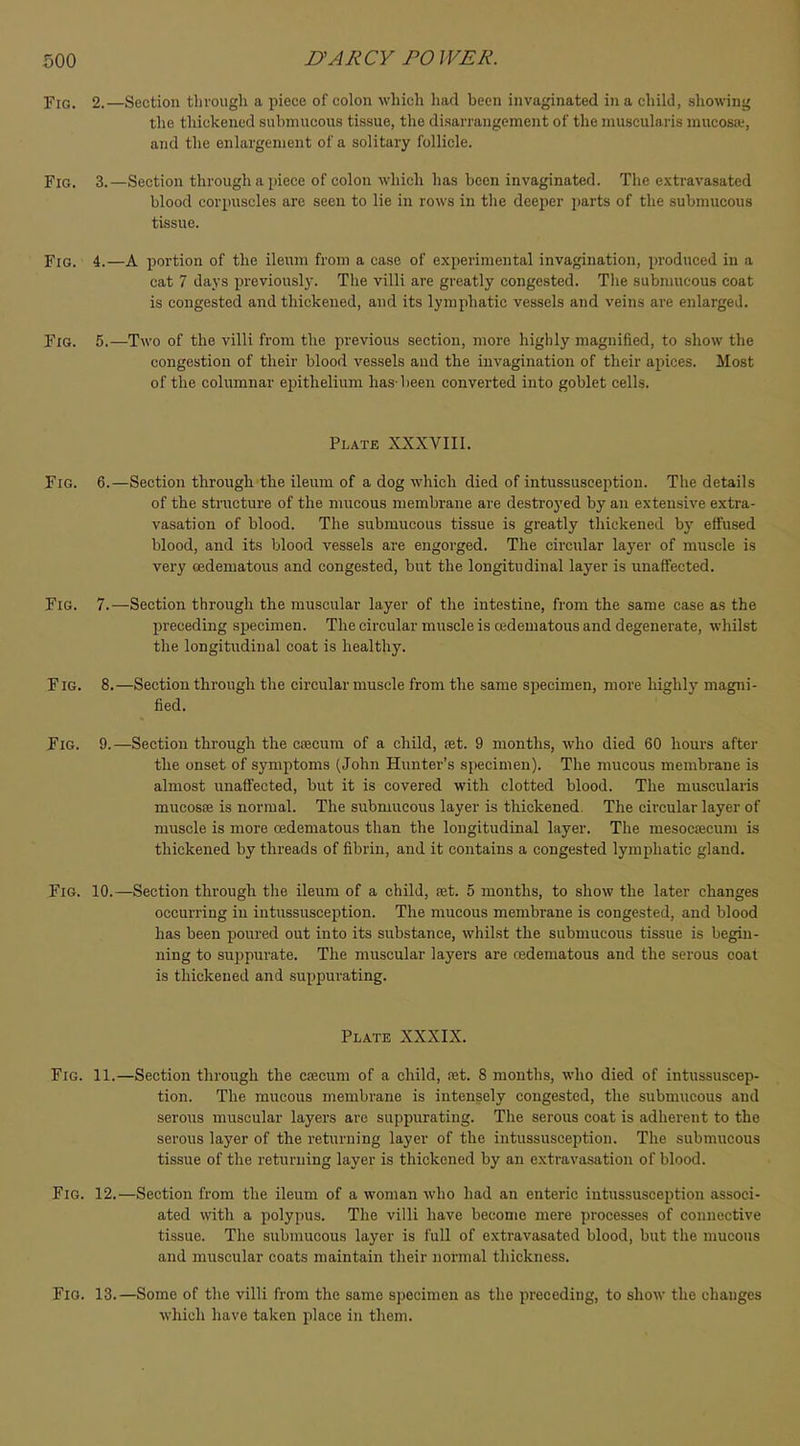 Fig. 2.—Section through a piece of colon which had been invaginated in a child, showing the thickened submucous tissue, the disarrangement of* the niuscularis mucosa', and the enlargement of a solitary follicle. Fig. 3.—Section through a piece of colon which has been invaginated. The extravasated blood corpuscles are seen to lie in rows in the deeper parts of the submucous tissue. Fig, 4.—a portion of the ileum from a case of experimental invagination, produced in a cat 7 days previously. The villi are greatly congested. The submucous coat is congested and thickened, and its lymphatic vessels and veins are enlarged. Fig. 5.—Two of the villi from the previous section, more highly magnified, to show the congestion of their blood vessels and the invagination of their apices. Most of the columnar epithelium has-been converted into goblet cells. Plate XXXVIII. Fig. 6.—Section through the ileum of a dog which died of intussusception. The details of the structure of the mucous membrane are destroyed by an extensive extra- vasation of blood. The submucous tissue is greatly thickened by effused blood, and its blood vessels are engorged. The circular layer of muscle is very cedeniatous and congested, but the longitudinal layer is unaffected. Fig. 7.—Section through the muscular layer of the intestine, from the same case as the preceding specimen. The circular muscle i s cedeniatous and degenerate, whilst the longitudinal coat is healthy. Fig. 8.—Section through the circular muscle from the same specimen, more highly magni- fied. Fig. 9.—Section through the esecum of a child, set. 9 months, who died 60 hours after the onset of symptoms (John Hunter's specimen). The mucous membrane is almost unaffected, but it is covered with clotted blood. The niuscularis mucosae is normal. The submucous layer is thickened. The circular layer of muscle is more cedeniatous than the longitudinal layer. The mesocsecum is thickened by threads of fibrin, and it contains a congested lymphatic gland. Fig. 10.—Section through the ileum of a child, set. 5 months, to show the later changes occurring in intussusception. The mucous membrane is congested, and blood has been poured out into its substance, whilst the submucous tissue is begin- ning to suppurate. The muscular layers are cedematous and the serous coat is thickened and suppurating. Plate XXXIX. Fig. 11.—Section through the csecum of a child, set. 8 months, who died of intussuscep- tion. The mucous membrane is intensely congested, the submucous and serous muscular layers arc suppurating. The serous coat is adherent to the serous layer of the returning layer of the intussusception. The submucous tissue of the returning layer is thickened by an extravasation of blood. Fig. 12.—Section from the ileum of a woman who had an enteric intussusception associ- ated with a polypus. The villi have become mere processes of connective tissue. The submucous layer is full of extravasated blood, but the mucous and muscular coats maintain their normal thickness. Fig. 13. —Some of the villi from the same specimen as the preceding, to show the changes which have taken place in them.