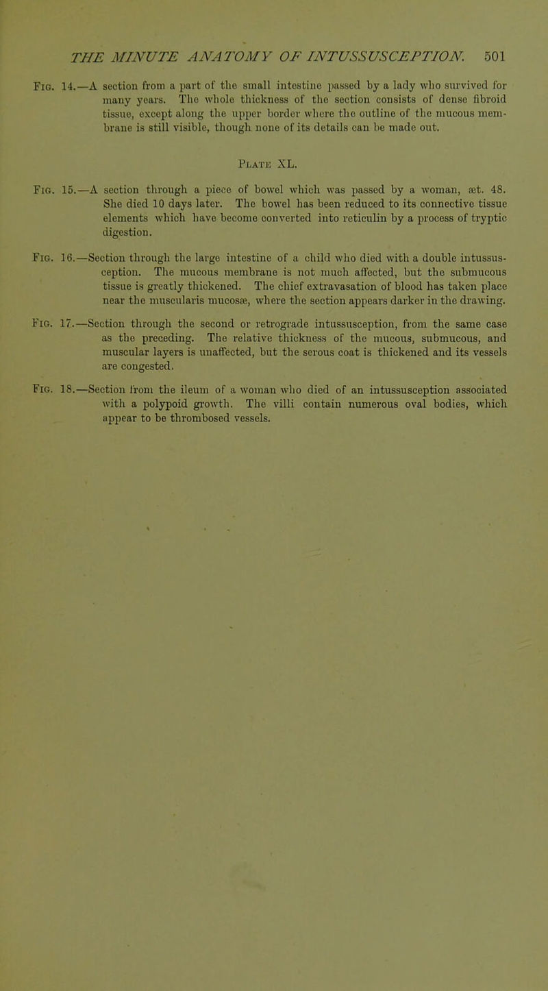 Fig. 14.—A section from a part of the small intestine passed by a lady who survived lor many years. The whole thickness of the section consists of dense fibroid tissue, except along the upper border where the outline of the mucous mem- brane is still visible, though none of its details can be made out. Plate XL. Fig. 15.—A section through a piece of bowel which was passed by a woman, set. 48. She died 10 days later. The bowel has been reduced to its connective tissue elements which have become converted into reticulin by a process of tryptic digestion. Fig. 16.—Section through the large intestine of a child who died with a double intussus- ception. The mucous membrane is not much affected, but the submucous tissue is greatly thickened. The chief extravasation of blood has taken place near the muscularis mucosce, where the section appears darker in the drawing. Fig. 17.—Section through the second or retrograde intussusception, from the same case as the preceding. The relative thickness of the mucous, submucous, and muscular layers is unaffected, but the serous coat is thickened and its vessels are congested. Fig. 18.—Section from the ileum of a woman who died of an intussusception associated with a polypoid growth. The villi contain numerous oval bodies, which iippear to be thrombosed vessels. %