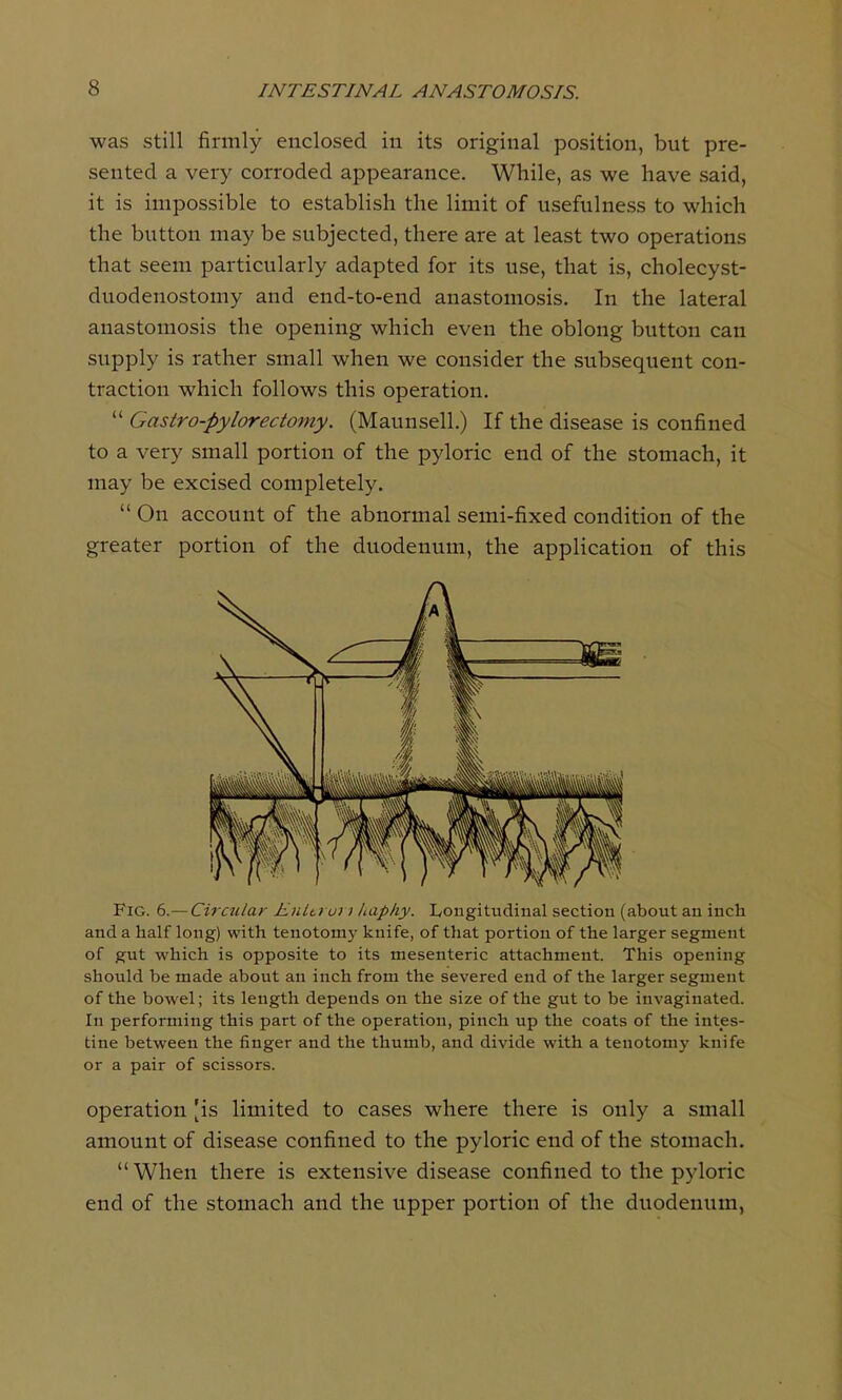 was still firmly enclosed in its original position, but pre- sented a very corroded appearance. While, as we have said, it is impossible to establish the limit of usefulness to which the button may be subjected, there are at least two operations that seem particularly adapted for its use, that is, cholecyst- duodenostomy and end-to-end anastomosis. In the lateral anastomosis the opening which even the oblong button can supply is rather small when we consider the subsequent con- traction which follows this operation.  Gastro-pylorectomy. (Maunsell.) If the disease is confined to a very small portion of the pyloric end of the stomach, it may be excised completely.  On account of the abnormal semi-fixed condition of the greater portion of the duodenum, the application of this Fig. 6.— Circular Eulti ui i haphy. Longitudinal section (about an inch and a half long) with tenotomy knife, of that portion of the larger segment of gut which is opposite to its mesenteric attachment. This opening should be made about an inch from the severed end of the larger segment of the bowel; its length depends on the size of the gut to be invaginated. In performing this part of the operation, pinch up the coats of the intes- tine between the finger and the thumb, and divide with a tenotomy knife or a pair of scissors. operation [is limited to cases where there is only a small amount of disease confined to the pyloric end of the stomach.  When there is extensive disease confined to the pyloric end of the stomach and the upper portion of the duodenum,