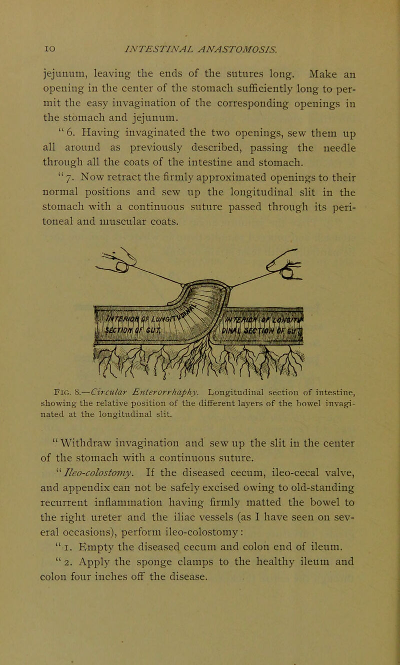 jejunum, leaving the ends of the sutures long. Make an opening in the center of the stomach sufficiently long to per- mit the easy invagination of the corresponding openings in the stomach and jejunum.  6. Having invaginated the two openings, sew them up all around as previously described, passing the needle through all the coats of the intestine and stomach.  7. Now retract the firmly approximated openings to their normal positions and sew up the longitudinal slit in the stomach with a continuous suture passed through its peri- toneal and muscular coats. Fig. S.—Circular Enterorrhaphy. Longitudinal section of intestine, showing the relative position of the different layers of the bowel invagi- nated at the longitudinal slit. Withdraw invagination and sew up the slit in the center of the stomach with a continuous suture.  Ileo-colostomy. If the diseased cecum, ileo-cecal valve, and appendix can not be safely excised owing to old-standing recurrent inflammation having firmly matted the bowel to the right ureter and the iliac vessels (as I have seen on sev- eral occasions), perform ileo-colostomy:  1. Empty the diseased cecum and colon end of ileum.  2. Apply the sponge clamps to the healthy ileum and colon four inches off the disease.