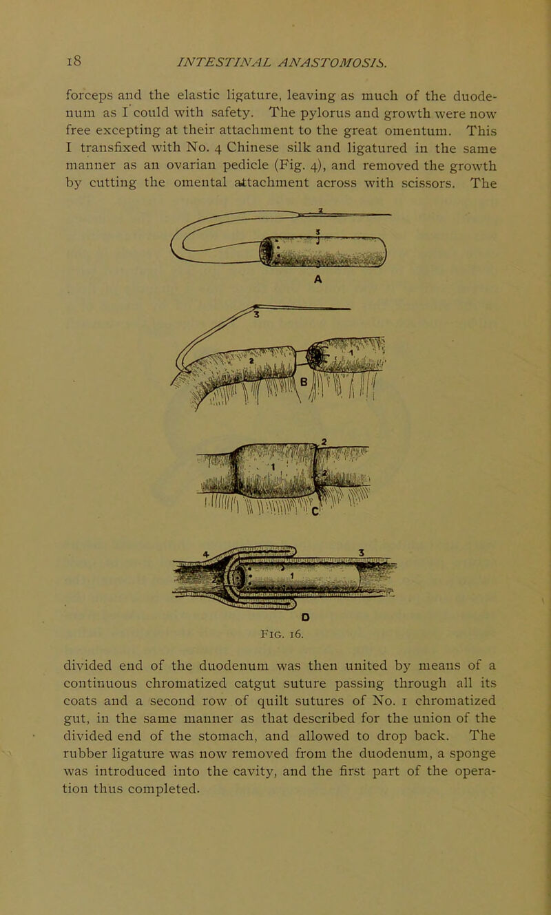 forceps and the elastic ligature, leaving as much of the duode- num as I could with safety. The pylorus and growth were now free excepting at their attachment to the great omentum. This I transfixed with No. 4 Chinese silk and ligatured in the same manner as an ovarian pedicle (Fig. 4), and removed the growth by cutting the omental attachment across with scissors. The o Fig. 16. divided end of the duodenum was then united by means of a continuous chromatized catgut suture passing through all its coats and a second row of quilt sutures of No. 1 chromatized gut, in the same manner as that described for the union of the divided end of the stomach, and allowed to drop back. The rubber ligature was now removed from the duodenum, a sponge was introduced into the cavity, and the first part of the opera- tion thus completed.