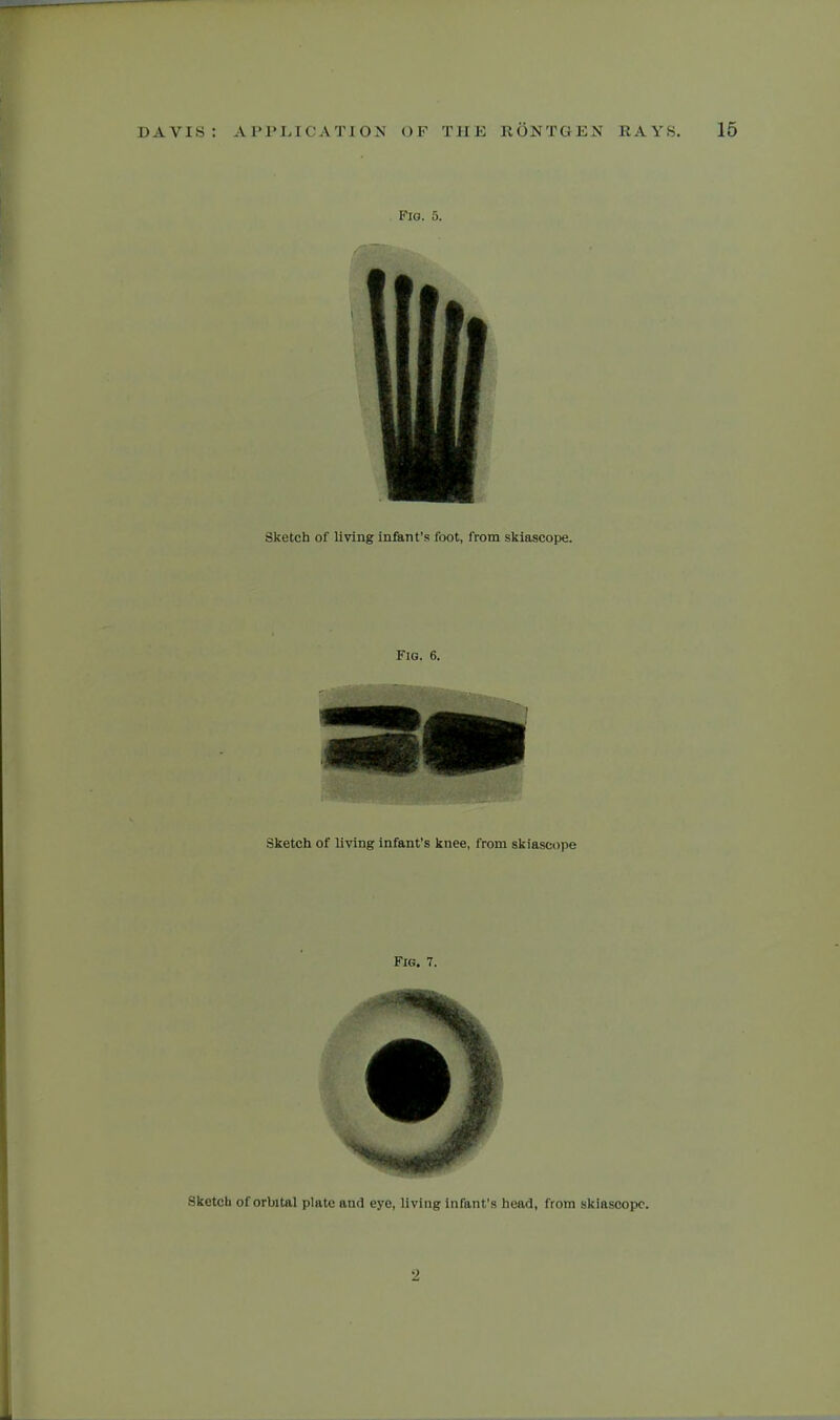 Fig. 5. Sketch of living infant's foot, from skiascope. Fig. 6. Sketch of living infant's knee, from skiascope Fig. 7. Sketch of orbital plate and eye, living infant's head, from skiascope. 2