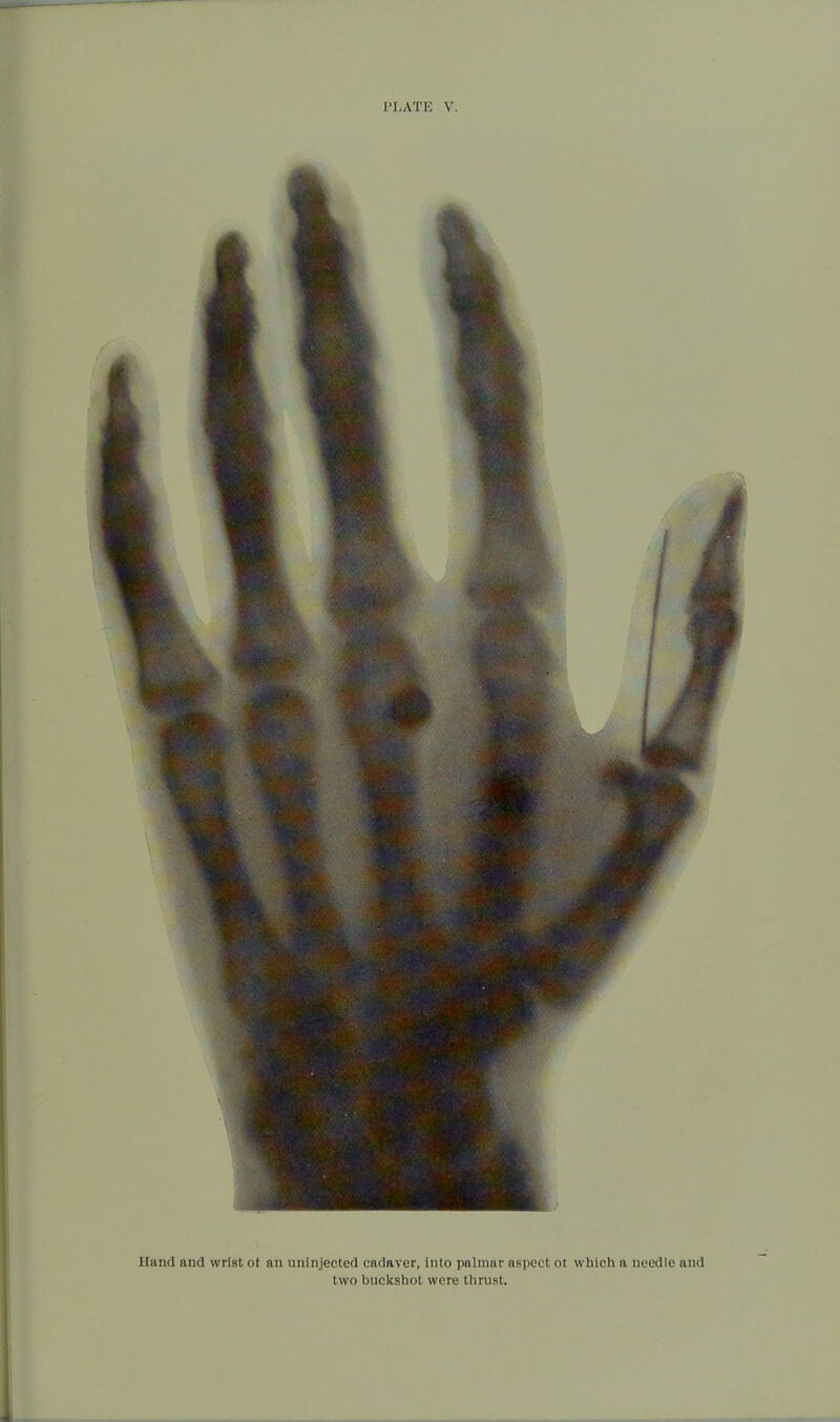 Hand and wrist oi nn mi injected cadaver, Into palmar aspect 01 which a needle and two buckshot were thrust.