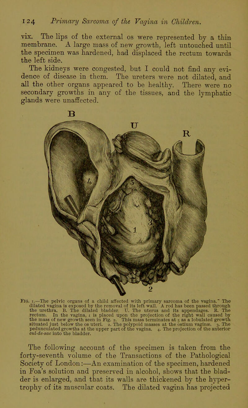 vix. The lips of the external os were represented by a thin membrane. A large mass of new growth, left untouched until the specimen was hardened, had displaced the rectum towards the left side. The kidneys were congested, but I could not find any evi- dence of disease in them. The ureters were not dilated, and all the other organs appeared to be healthy. There were no secondary growths in any of the tissues, and the lymphatic glands were unaffected. Fig. i.—The pelvic organs of a cliilil affected with primary sarcoma of the vagina. The dilated vagina is exposed by the removal of its left wall. A rod has been passed through the urethra. B. The dilated bladder. U. The uterus and its appendages. K. I'll.' rectum. In the vagina, i is placed upon the projection of the right wall caused by the mass of new growth seen in Fig. 2. This mass terminates at 5 as a lobulated growth situated just below the os uteri. 2. The polypoid masses at the ostium vagina?. 3. The pedunculated growths at the upper part of the vagina. 4. The projection of the anterior cul-de-sac into the bladder. The following account of the specimen is taken from the forty-seventh volume of the Transactions of the Pathological Society of London:—An examination of the specimen, hardened in Foa's solution and preserved in alcohol, shows that the blad- der is enlarged, and that its walls are thickened by the hyper- trophy of its muscular coats. The dilated vagina has projected