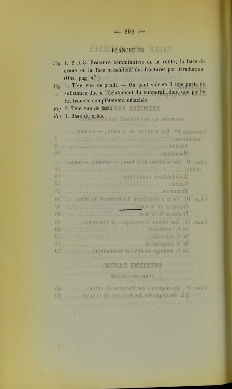 ^202 — PLANCHE 111. Fiy. I, 2 et 3. Fracture coïKminutive de la voûte; la base du crâne et la face présentent des fractures par irradiation. (Obs. pag. 47.) Fiy. 1. Tête vue de profil. — On peut voir en B une pprte de substance due à l'éclatement du temporal, dont une partie fut trouvée complètement détachée. Fig. f. Tête vue de face. d^iiiiMaH*! Fiy. 3. Base„d,u^,cjâae.^^, ^, ^^^^ — ;89J9iiev — , eJûov : f(j*)eil aarw/j 81 i^MI 06 .. . tiiiii'ia ub gyTuiofiil oG .111 .^auJ GÔ . . - .ô^fid gI sh ssiulosiT 80 . , .'i' ?'>r!riii'*nr'r»» (toîyô! ^1(1 ¥î .^ahO J^T .00 ' tsi b(i ÎITHA^ 3M3IXU3a