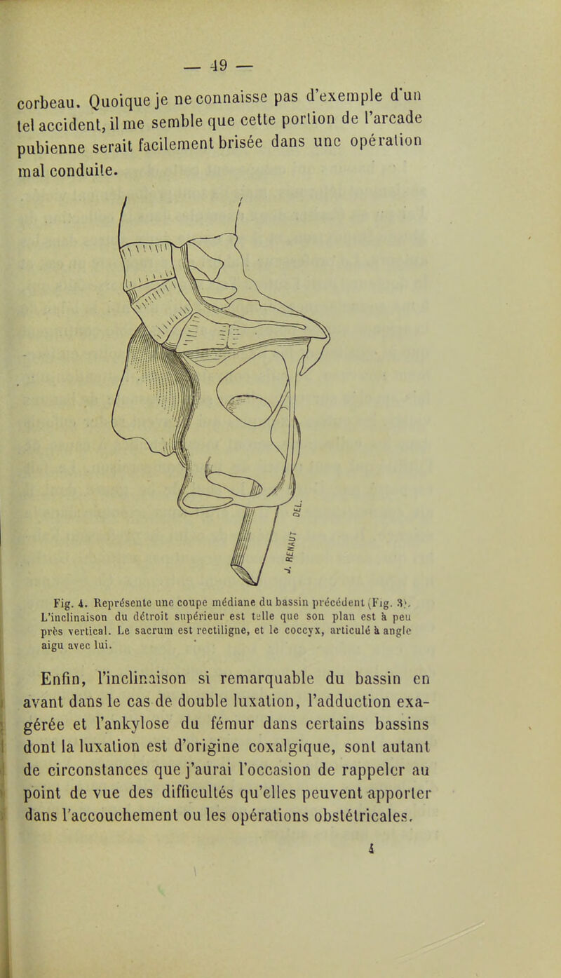 corbeau. Quoique je ne connaisse pas d'exemple d'un tel accident, il me semble que cette portion de l'arcade pubienne serait facilement brisée dans une opération mal conduite. Fig. i. Représente une coupe médiane du bassin précédent vFig. 3). L'inclinaison du détroit supérieur est U\\e que son plan est à peu près vertical. Le sacrum est rectiligne, et le coccyx, articulé a angle aigu avec lui. Enfin, l'inclinaison si remarquable du bassin en avant dans le cas de double luxation, l'adduction exa- gérée et l'ankylose du fémur dans certains bassins dont la luxation est d'origine coxalgique, sont autant de circonstances que j'aurai l'occasion de rappeler au point de vue des difficultés qu'elles peuvent apporter dans l'accouchement ou les opérations obstétricales.