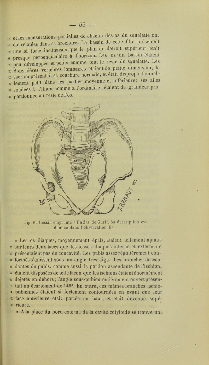 « et les mensurations partielles de chacun des os du squelette ont « été relatées dans sa brochure. Le bassin de cette fille présentait « un- si forte inclinaison que le plan du détroit supérieur était « presque perpendiculaire à l'horizon. Les os du bassin étaient « peu développés et petits comme tout le reste du squelette. Les « 2 dernières vertèbres lombaires étaient de petite dimension, le « sacrum présentait sa courbure normale, et était disproportionnel- « lement petit dans les parties moyenne et inférieure; ses ailes « soudées à l'ilium comme à l'ordinaire, étaient de grandeur pro- « portionnée au reste de l'os. Fig. 6. Bassin emprunté h l'Atlas de Guilt. Sa description est donnée dans l'observation G* « Les os iliaques, moyennement épais, étaient tellement aplatis « sur leurs deux faces que les fosses iliaques interne et externe ne « présentaient pas de concavité. Les pubis assez régulièrement con- « formés s'unissent sous un angle très-aigu. Les branches descen- « dantes du pubis, comme aussi la portion ascendante de l'ischion, « étaient disposées de telle façon que lesischionsétaienténormémenl « déjetés en dehors; l'angle sous-pubien entièrement ouvertprésen- « tait un écartement de 449°. En outre, ces mêmes branches ischio- « pubiennes étaient si fortement contournées en avant que leur « face antérieure était portée en haut, et était devenue supé- « rieure. « A la place du bord externe de la cavité cotyloïde se trouve une