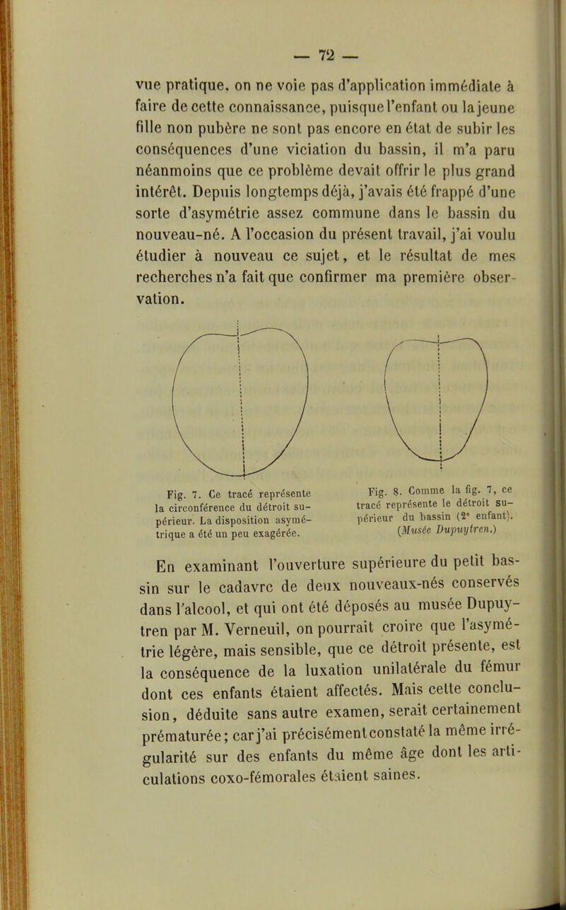 vue pratique, on ne voie pas d'application immédiate à faire de cette connaissance, puisque l'enfant ou la jeune fille non pubère ne sont pas encore en état de subir les conséquences d'une viciation du bassin, il m'a paru néanmoins que ce problème devait offrir le plus grand intérêt. Depuis longtemps déjà, j'avais été frappé d'une sorte d'asymétrie assez commune dans le bassin du nouveau-né. A l'occasion du présent travail, j'ai voulu étudier à nouveau ce sujet, et le résultat de mes recherches n'a fait que confirmer ma première obser- vation. En examinant l'ouverture supérieure du petit bas- sin sur le cadavre de deux nouveaux-nés conservés dans l'alcool, et qui ont été déposés au musée Dupuy- tren par M. Verneuil, on pourrait croire que l'asymé- trie légère, mais sensible, que ce détroit présente, est la conséquence de la luxation unilatérale du fémur dont ces enfants étaient affectés. Mais celte conclu- sion, déduite sans autre examen, serait certainement prématurée; car j'ai précisémenteonstaté la même irré- gularité sur des enfants du même âge dont les arti- culations coxo-fémorales étaient saines. Fig. 7. Ce tracé représente la circonférence du détroit su- périeur. La disposition asymé- trique a été un peu exagérée. Fig. 8. Comme la fig. 7, ce tracé représente le détroit su- périeur du bassin (2 enfant). {Musée Dupuytren.)