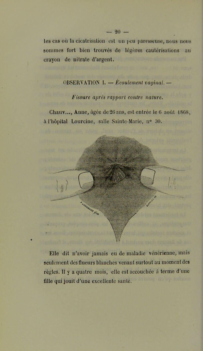 les cas où la cicaliisalioii est un peu paresseuse, nous nous sommes fort bien trouvés de légères cautérisations au crayon de nitrate d'argent. OBSERVATION I. — Écoulcmenl vaginal. — Fissure après rapport contre nalurc. Chauv..., Anne, âgée de26ans, est entrée le 6 août 1868, à l'hôpital Lourcine, salle Sainte-Marie, n° 30. Elle dit n'avoir jamais eu de maladie vénérienne, mais seulement des flueurs blanches venant surtout au moment des règles. 11 y a quatre mois, elle est accouchée à terme d'une fille qui jouit d'une excellente santé. /