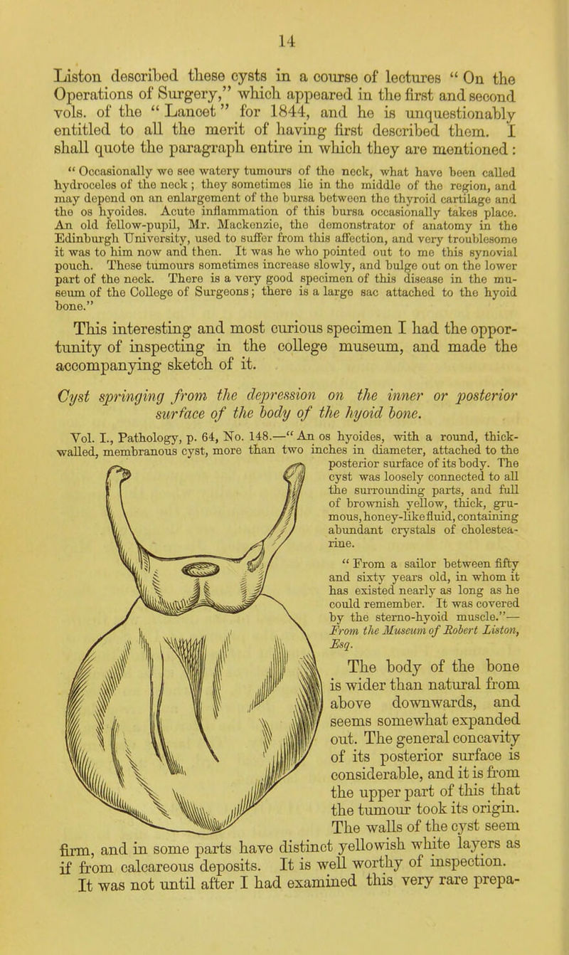 Liston described these cysts in a course of lectures On the Operations of Surgery, which appeared in the first and second vols, of the Lancet for 1844, and he is unquestionably entitled to aU the merit of having first described them. I shall quote the paragraph entire in which they are mentioned : Occasionally wo see watory tumours of tho nock, what have been called hydrocolos of the nock ; they sometimes lie in tho middle of the region, and may depend on an enlargement of the bursa between the thyroid cartilage and tho 08 hyoides. Acute inflammation of this bursa occasionally takes place. An old fellow-pupil, Mr. Mackenzie, the demonstrator of anatomy in the Edinburgh University, used to suffer from this affection, and very troublesome it was to him now and then. It was he who pointed out to me this synovial pouch. Those tumours sometimes increase slowly, and bulge out on the lower part of the neck. There is a very good specimen of this disease in the mu- seum of the College of Surgeons; there is a large sac attached to the hyoid bone. This interesting and most curious specimen I had the oppor- tunity of inspecting in the college museum, and made the accompanying sketch of it. Cyst springing from the depression on the inner or posterior surface of the body of the hyoid hone. Vol. I., Pathology, p. 64, No. 148.— An os hyoides, with a round, thick- walled, membranous cyst, more than two inches in diameter, attached to the posterior surface of its body. The cyst was loosely connected to all the surrounding parts, and full of brownish yellow, tldck, gru- mous, honey-like fluid, containing abimdant crystals of cholestea- rine. From a sailor between fifty and sixty years old, in whom it has existed nearly as long as he could remember. It was covered by the sterno-hyoid muscle.— From the Mmcum of Robert Liston, Esq. The body of the bone is wider than natural from above downwards, and seems somewhat expanded out. The general concavity of its posterior surface is considerable, and it is fi'om the upper part of this that the tumour took its origin. The walls of the cyst seem firm, and in some parts have distinct yellowish white layers as if from calcareous deposits. It is well worthy of mspection. It was not until after I had examined this very rare prepa-