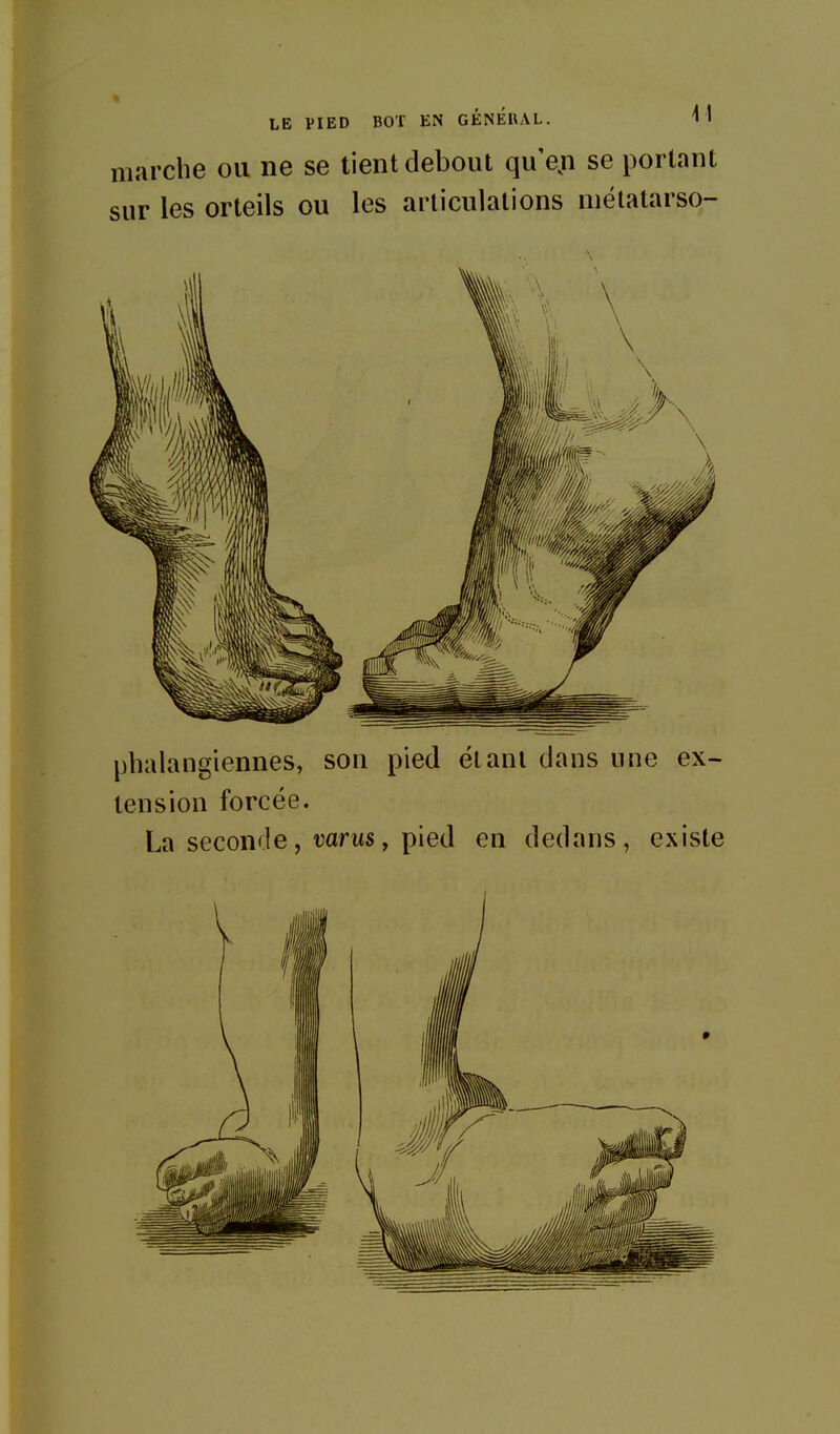 marche ou ne se tient debout qu'eji se portant sur les orteils ou les articulations niétatarso- phalangiennes, sou pied étant dans une ex- tension forcée. La seconde, mrus, pied en dedans, existe