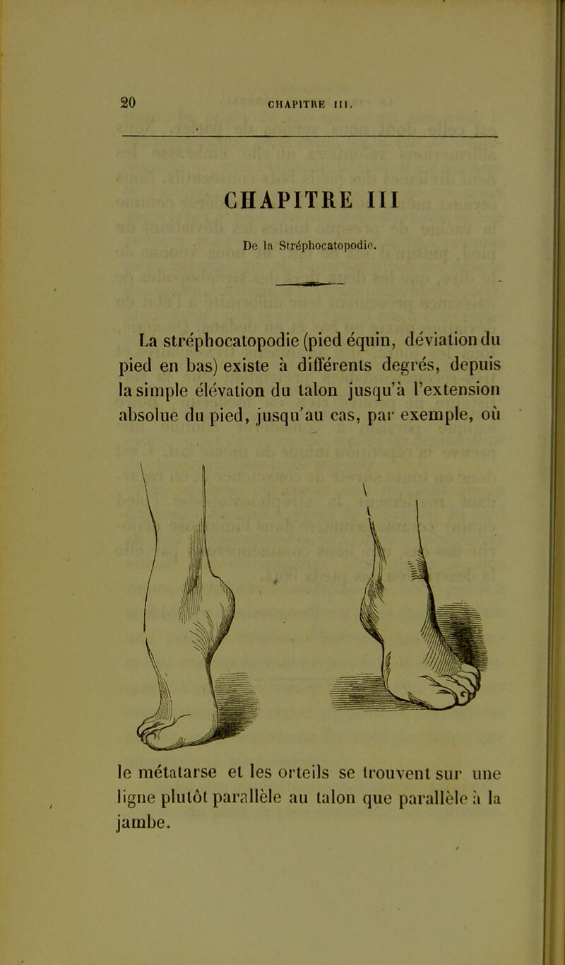 CHAPITRE III De la Stréphocatopodio. La strépbocatopodie (pied équin, déviation du pied en bas) existe à différents degrés, depuis la simple élévation du talon jusqu'à l'extension absolue du pied, jusqu'au cas, par exemple, où le métatarse et les orteils se trouvent sur une ligne plutôt parallèle au talon que parallèle à la jambe.