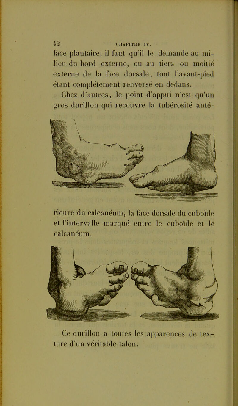 face planlairej il faul qu'il le demande au mi- lieu du bord externe, ou au liers ou moitié exlerne de la face dorsale, tout l'avant-pied étant com[)lélemeni renversé en dedans. Chez d'aulres, le point d'appui n'est qu'un gros duiillon qui recouvre la tubérosilé anté- rieui'e du calcanéum, la face dorsale du cuboïde et l'intervalle marqué enire le cuboïde et le calcanéum. Ce durillon a toutes les appaiences de tex- ture d'un véritable lalon.