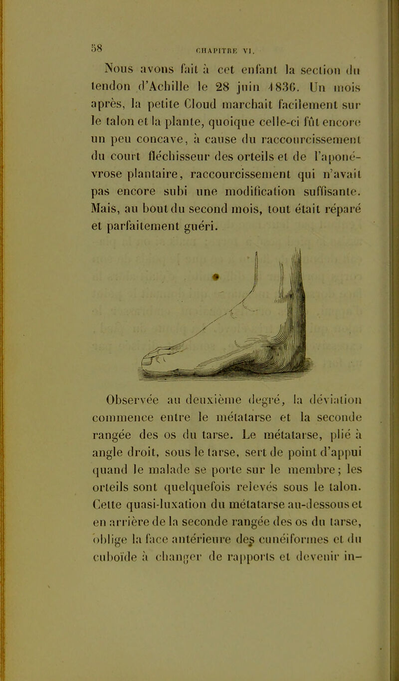 Nous avons fait ù cet enfant la section du tendon d'Achille le 28 jnin ^830. Un mois après, la petite Cloud marchait facilement sur le talon et la plante, quoique celle-ci fût encore un peu concave, à cause du raccourcissement du court fléchisseur des orteils et de l'aponé- vrose plantaire, raccourcissement qui n'avait pas encore subi une modification suffisante. Mais, au bout du second mois, tout était réparé et parfaitement guéri. Observée au deuxième degi'é, la déviation commence entre le métatarse et la seconde rangée des os du tarse. Le métatarse, plié à angle droit, sous le tarse, sert de point d'appui quand le malade se porte sur le membre; les orteils sont quelquefois relevés sous le talon. Celte quasi-luxation du métatarse au-dessous et en arrière de la seconde rangée des os du tarse, oblige lîi face antérieure de^ cunéiformes et du cuboïde à clianfjer de rapports et devenir in-