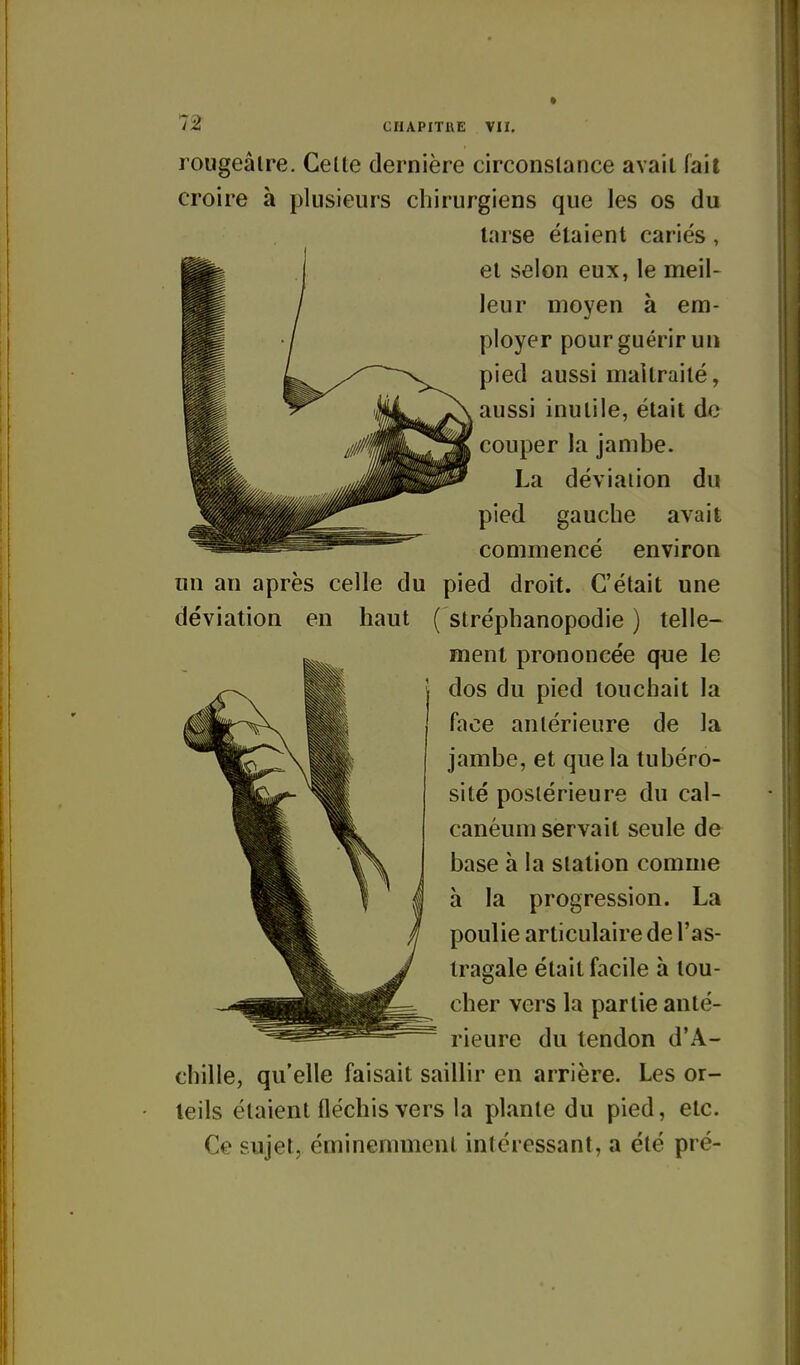 lougeâlre. Celte dernière circonstance avait fait croire à plusieurs chirurgiens que les os du tarse étaient cariés, et selon eux, le meil- leur moyen à em- ployer pour guérir un pied aussi maltraité, aussi inutile, était de couper la jambe. La déviation du pied gauche avait commencé environ un an après celle du pied droit. C'était une déviation en haut ( stréphanopodie ) telle- ment prononcée que le dos du pied touchait la face antérieure de la jambe, et que la tubéro- sité postérieure du cal- canéum servait seule de base à la station comme à la progression. La poulie articulaire de l'as- tragale était facile à tou- cher vers la partie anté- rieure du tendon d'A- chille, qu'elle faisait saillir en arrière. Les or- teils étaient fléchis vers la plante du pied, etc. Ce sujet, éminemment intéressant, a été pré-