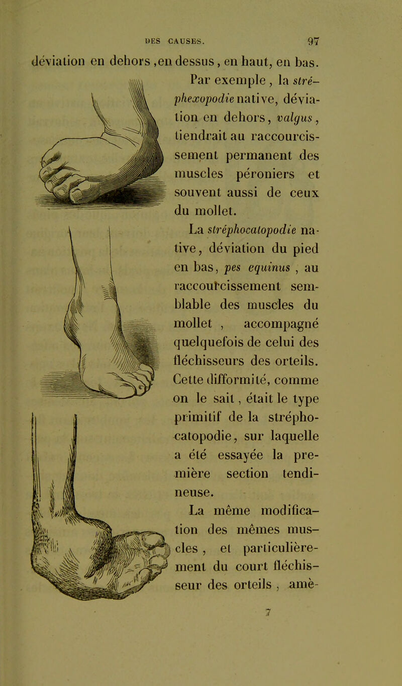 déviation en dehors ,en dessus, en haut, en bas. Par exemple , la stré- phexopodie nal\\e, dévia- tion en dehors, valgus, tiendrait au raccourcis- sement permanent des muscles péroniers et souvent aussi de ceux du mollet. La stréphocalopodie na- tive, déviation du pied en bas, pes equinus , au raccou^cissement sem- blable des muscles du mollet , accompagné quelquefois de celui des fléchisseurs des orteils. Cette difformité, comme on le sait, était le type primitif de la strépho- catopodie, sur laquelle a été essayée la pre- mière section tendi- neuse. La même modifica- tion des mêmes mus- cles , et particulière- ment du court fléchis- seur des orteils , amè- 7
