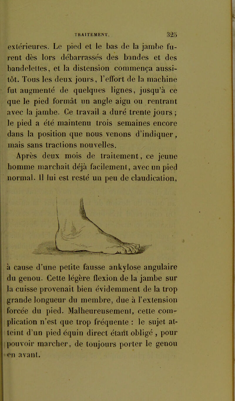 extérieures. Le pied et le bas de la jambe fu- rent dès lors débarrassés des bandes et des bandelettes, et la distension commença aussi- tôt. Tous les deux jours, l'effort de la machine fut augmenté de quelques lignes, jusqu'à ce que le pied format un angle aigu ou rentrant avec la jambe. Ce travail a duré trente jours ; le pied a été maintenu trois semaines encore dans la position que nous venons d'indiquer, mais sans tractions nouvelles. Après deux mois de traitement, ce jeune homme marchait déjà facilement, avec un pied normal. 11 lui est resté un peu de claudication, à cause d'une petite fausse ankylose angulaire du genou. Cette légère flexion de la jambe sur la cuisse provenait bien évidemment de la trop grande longueur du membre, due à l'extension forcée du pied. Malheureusement, cette com- plication n'est que trop fréquente : le sujet at- teint d'un pied équin direct étant obligé , pour Ipouvoir marcher, de toujours porter le genou en avant.