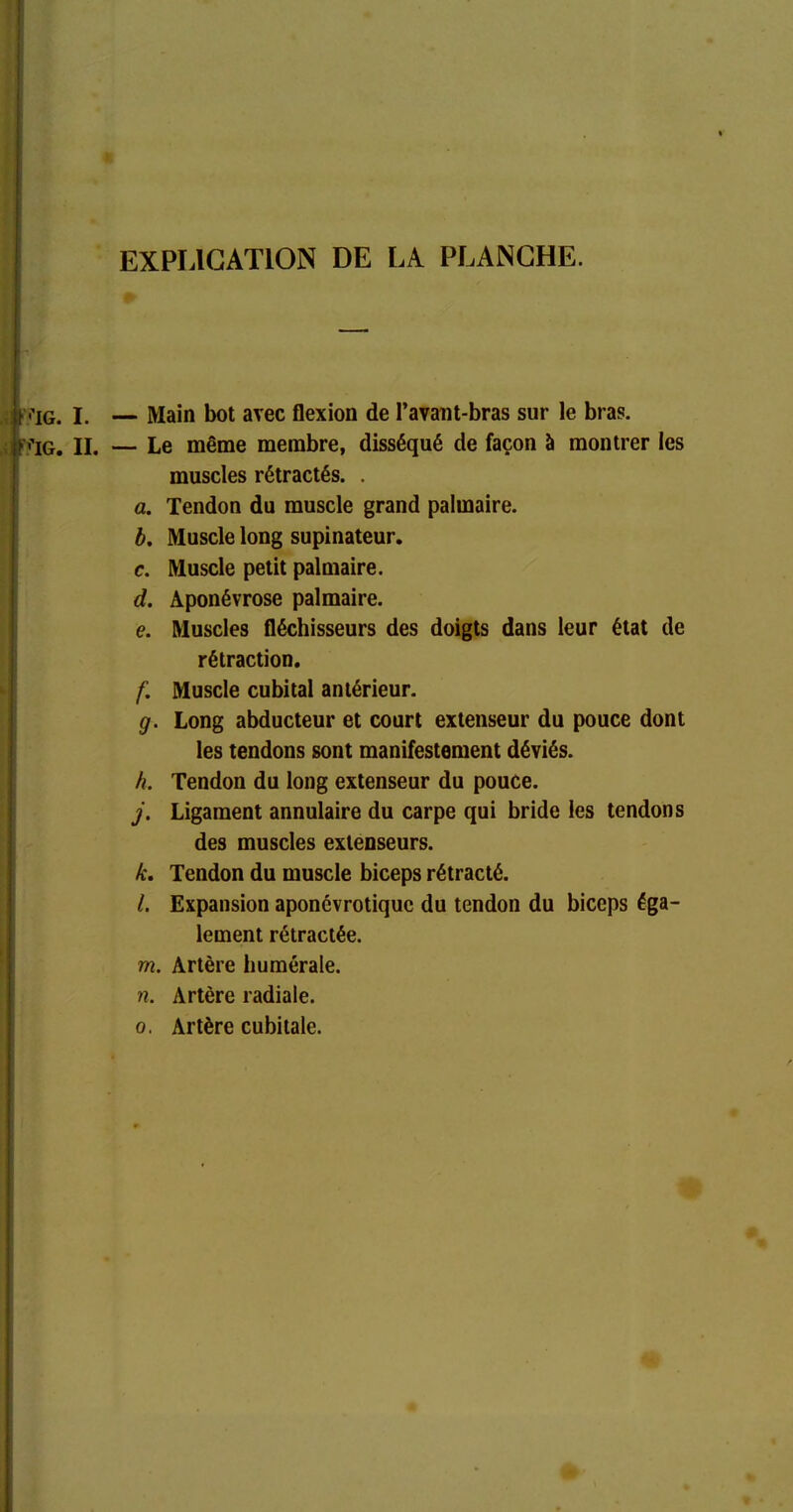 EXPLICATION DE LA PLANCHE. 'IG. i. — Main bot avec flexion de l’avant-bras sur le bras. IG. II. — Le même membre, disséqué de façon à montrer les muscles rétractés. . a. Tendon du muscle grand palmaire. b. Muscle long supinateur. c. Muscle petit palmaire. d. Aponévrose palmaire. e. Muscles fléchisseurs des doigts dans leur état de rétraction. f. Muscle cubital antérieur. g. Long abducteur et court extenseur du pouce dont les tendons sont manifestement déviés. h. Tendon du long extenseur du pouce. j. Ligament annulaire du carpe qui bride les tendons des muscles extenseurs. k. Tendon du muscle biceps rétracté. l. Expansion aponévrotiquc du tendon du biceps éga- lement rétractée. m. Artère humérale. n. Artère radiale. o. Artère cubitale.