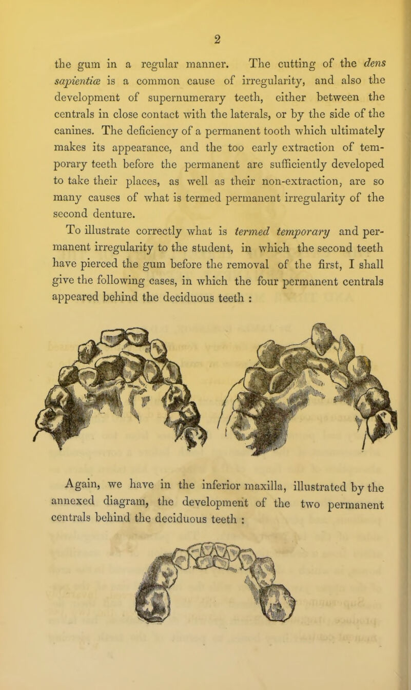 the gum in a regular manner. The cutting of the dens sapientice is a common cause of irregularity, and also the development of supernumerary teeth, either between the centrals in close contact with the laterals, or by the side of the canines. The deficiency of a permanent tooth which ultimately makes its appearance, and the too early extraction of tem- porary teeth before the permanent are sufficiently developed to take their places, as well as their non-extraction, are so many causes of what is termed permanent irregularity of the second denture. To illustrate correctly what is termed temporary and per- manent irregularity to the student, in which the second teeth have pierced the gum before the removal of the first, I shall give the following cases, in which the four permanent centrals appeared behind the deciduous teeth : Again, we have in the inferior maxilla, illustrated by the annexed diagram, the development of the two permanent centrals behind the deciduous teeth :