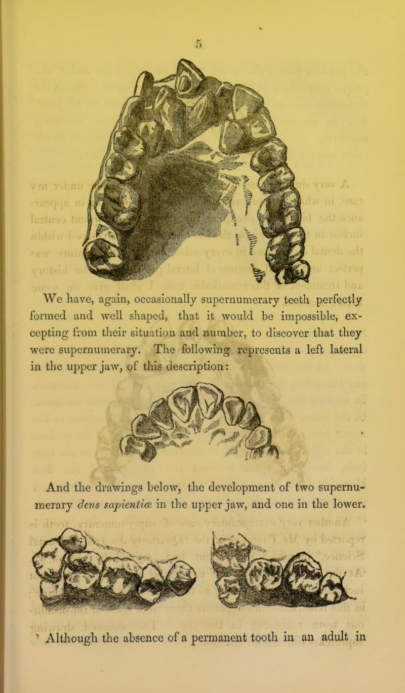 We have, again, occasionally supernumerary teeth perfectly formed and well shaped, that it would be impossible, ex- cepting from their situation and number, to discover that they were supernumerary. The following represents a left lateral in the upper jaw, of this description: ' Although the absence of a permanent tooth in an adult in