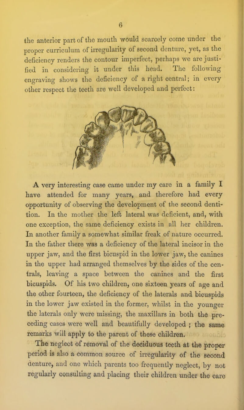 the anterior part of the moutli would scarcely come under the proper curriculum of irregularity of second denture, yet, as the deficiency renders the contour imperfect, perhaps we are justi- fied in considering it under this head. The following engraving shows the deficiency of a right central; in every other respect tlie teeth are well developed and perfect: A very interesting case came under my care in a family I have attended for many years, and therefore had every opportunity of observing the development of the second denti- tion. In the mother the left lateral was deficient, and, with one exception, the same deficiency exists in all her children. In another family a somewhat similar freak of nature occurred. In the father there was a deficiency of the lateral incisor in the upper jaw, and the first bicuspid in the lower jaw, the canines in the upper had arranged themselves by the sides of the cen- trals, leaving a space between the canines and the first bicuspids. Of his two children, one sixteen years of age and the other fourteen, the deficiency of the laterals and bicuspids in the lower jaw existed in the former, whilst in the younger the laterals only were missing, the maxillars in both the pre- ceding cases were well and beautifully developed ; the same remarks will apply to the parent of these children. The neglect of removal of the deciduous teeth at the proper period is also a common source of irregularity of the second denture, and one which parents too frequently neglect, by not regularly consulting and placing their children under the care