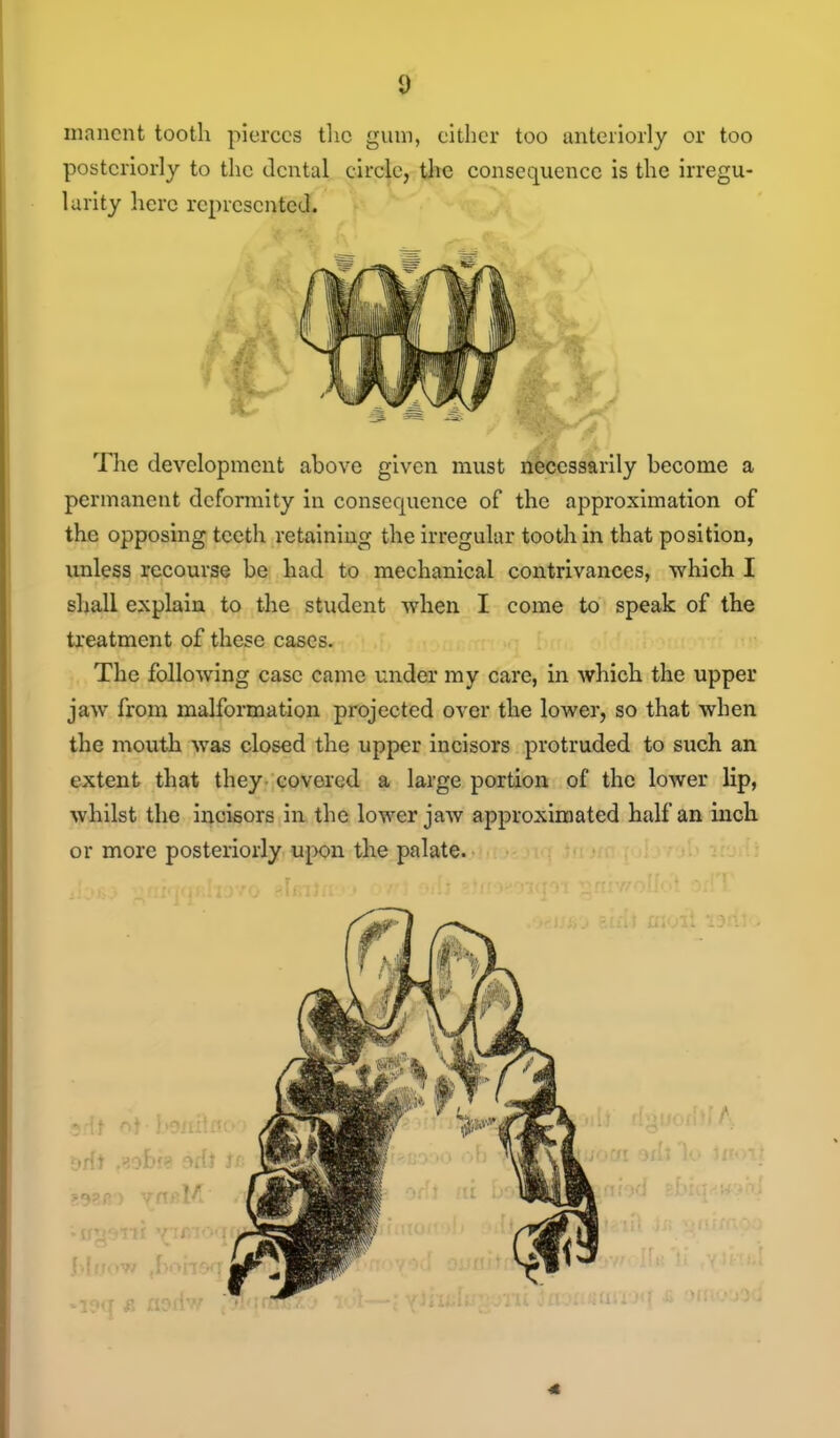 inancnt tooth pierces the gum, either too anteriorly or too posteriorly to the dental circle, the consequence is the irregu- larity here represented. The development above given must necessarily become a permanent deformity in consequence of the approximation of the opposing teeth retaining the irregular tooth in that position, unless recourse be had to mechanical contrivances, -svhich I shall explain to the student when I come to speak of the treatment of these cases. The following case came under my care, in which the upper jaw from malformation projected over the lower, so that when the mouth was closed the upper incisors protruded to such an extent that they covered a large portion of the lower lip, whilst the incisors in the lower jaw approximated half an inch or more posteriorly upon the palate.