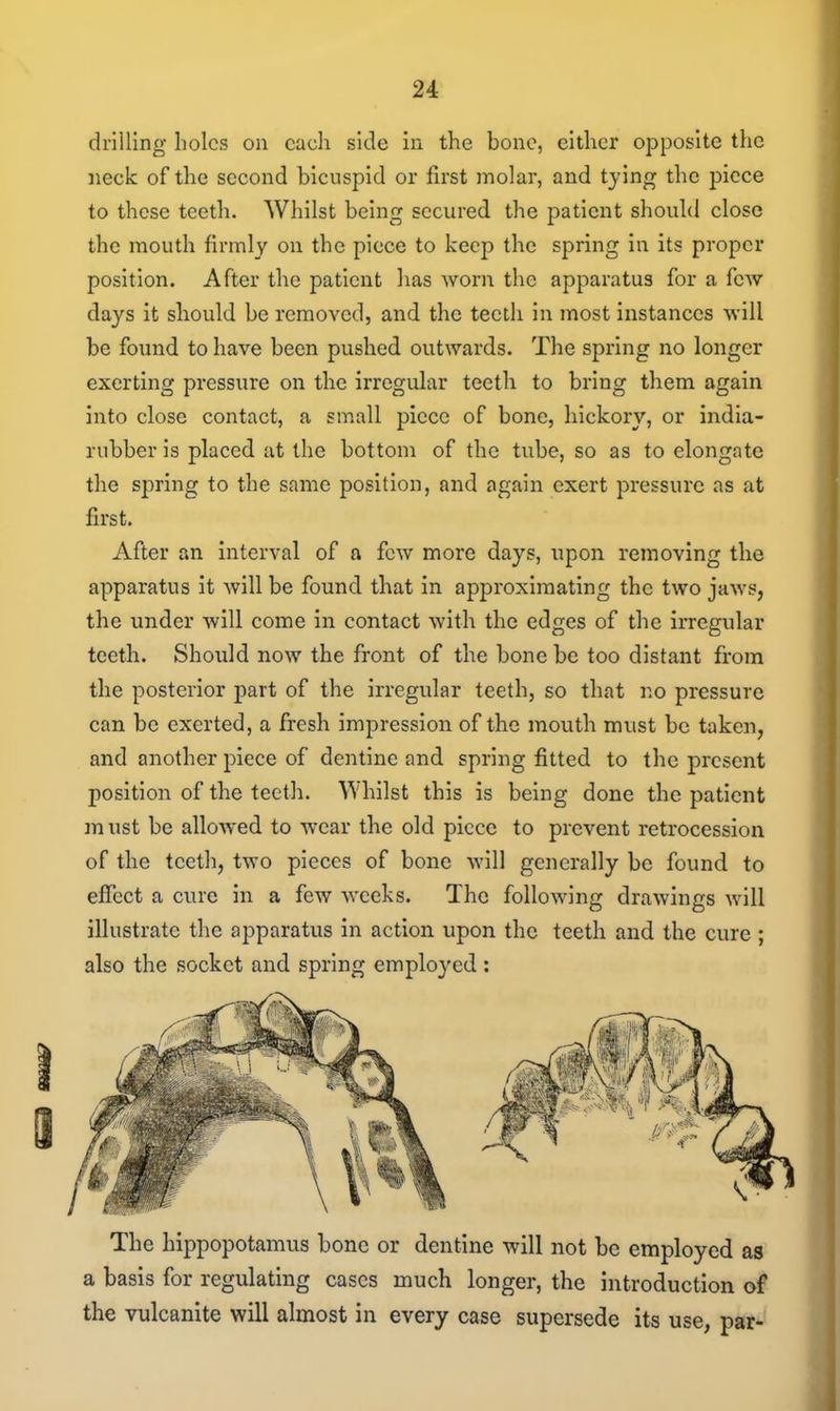 u drilling holes on each side in the bone, either opposite the neck of the second bicuspid or first molar, and tying the piece to these teeth. Whilst being secured the patient should close the mouth firmly on the piece to keep the spring in its proper position. After the patient has worn the apparatus for a few days it should be removed, and the teeth in most Instances ■will be found to have been pushed outwards. The spring no longer exerting pressure on the irregular teetli to bring them again into close contact, a small piece of bone, hickory, or india- rubber is placed at the bottom of the tube, so as to elongate the spring to the same position, and again exert pressure as at first. After an interval of a few more days, upon removing the apparatus It will be found that in approximating the two jaws, the under will come in contact with the edges of the irregular teeth. Should now the front of the bone be too distant from the posterior part of the irregular teeth, so that no pressure can be exerted, a fresh impression of the mouth must be taken, and another piece of dentine and spring fitted to the present position of the teeth. Whilst this is being done the patient must be allowed to wear the old piece to prevent retrocession of the teeth, two pieces of bone will generally be found to effect a cure in a few weeks. The following drawings avHI illustrate the apparatus in action upon the teeth and the cure ; also the socket and spring employed: The hippopotamus bone or dentine will not be employed as a basis for regulating cases much longer, the introduction of the vulcanite will almost in every case supersede its use, par*'