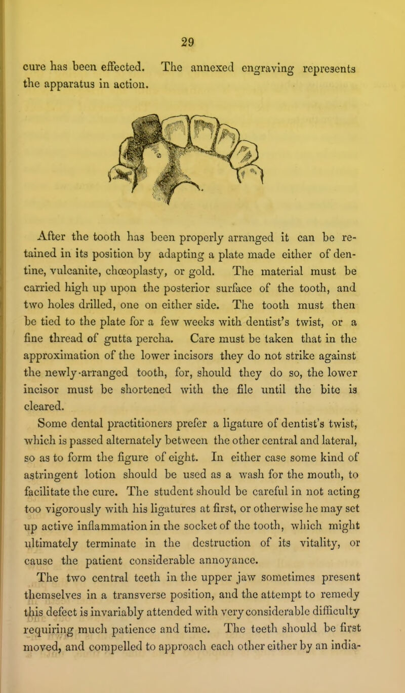 cure has been effected. The annexed engraving represents the apparatus in action. After the tooth has been properly arranged it can be re- tained in its position by adapting a plate made either of den- tine, vulcanite, choeoplasty, or gold. The material must be carried high up upon the posterior surface of the tooth, and two holes drilled, one on either side. The tooth must then be tied to the plate for a few weeks with dentist's twist, or a fine thread of gutta percha. Care must be taken that in the approximation of the lower incisors they do not strike against the newly-arranged tooth, for, should they do so, the lower incisor must be shortened with the file until the bite is cleared. Some dental practitioners prefer a ligature of dentist's twist, ■which is passed alternately between the other central and lateral, so as to form the figure of eight. In either case some kind of astringent lotion should be used as a wash for the mouth, to facilitate the cure. The student should be careful in not acting too vigorously with his ligatures at first, or otherwise he may set up active inflammation in ihe socket of the tooth, which might ultimately terminate in the destruction of its vitality, or cause the patient considerable annoyance. The two central teeth in tlie upper jaw sometimes present themselves in a transverse position, and the attempt to remedy this defect is invariably attended with very considerable difficulty requiring much patience and time. The teeth should be first moved, and compelled to approach each other either by an India-