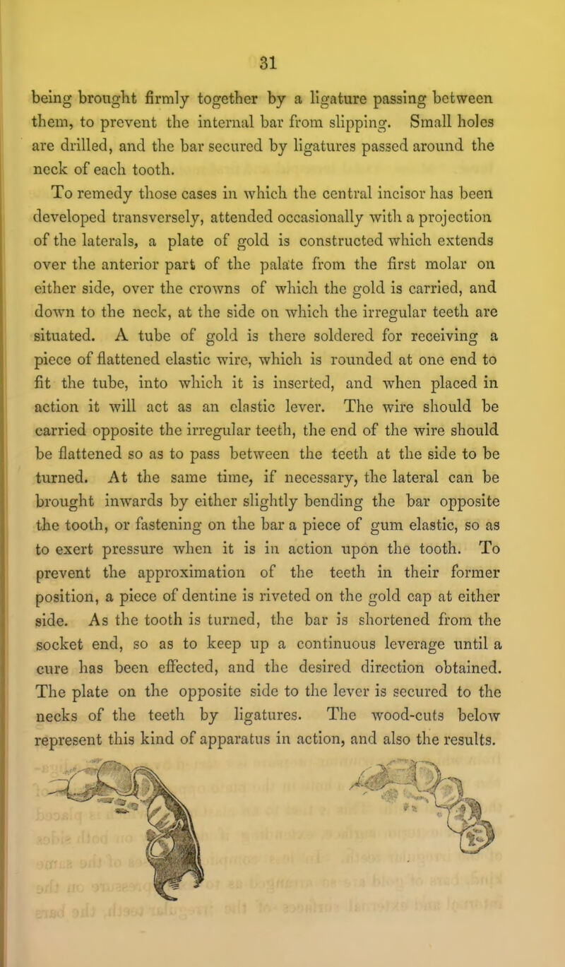 being brouglit firmly together by a ligature passing between them, to prevent the internal bar from slipping. Small holes are drilled, and the bar secured by ligatures passed around the neck of each tooth. To remedy those cases in which the central incisor has been developed transversely, attended occasionally with a projection of the laterals, a plate of gold is constructed which extends over the anterior part of the palate from the first molar on either side, over the crowns of which the gold is carried, and down to the neck, at the side on which the irregular teeth are situated. A tube of gold is there soldered for receiving a piece of flattened elastic wire, which is rounded at one end to fit the tube, into which it is inserted, and when placed in action it will act as an clastic lever. The wire should be carried opposite the irregular teeth, the end of the wire should be flattened so as to pass between the teeth at the side to be turned. At the same time, if necessary, the lateral can be brought inwards by either slightly bending the bar opposite the tooth, or fastening on the bar a piece of gum elastic, so as to exert pressure when it is in action upon the tooth. To prevent the approximation of the teeth in their former position, a piece of dentine is riveted on the gold cap at either side. As the tooth is turned, the bar is shortened from the socket end, so as to keep up a continuous leverage until a cure has been effected, and the desired direction obtained. The plate on the opposite side to the lever is secured to the necks of the teeth by ligatures. The wood-cuts below represent this kind of apparatus in action, and also the results.