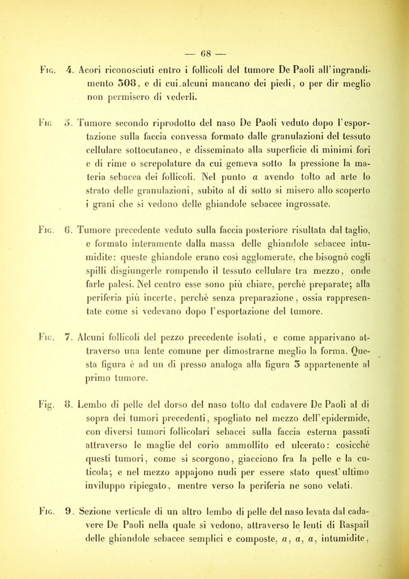 Fjg. 4. Acori riconosciuti entro i follicoli del tumore De Paoli all’ingrandi- mento 508, e di cui.alcuni mancano dei piedi, o per dir meglio non permisero di vederli. Fig 8. Tumore secondo riprodotto del naso De Paoli veduto dopo l’espor- tazione sulla faccia convessa formato dalle granulazioni del tessuto cellulare sottocutaneo, e disseminato alla superficie di minimi fori e di rime o screpolature da cui gemeva sotto la pressione la ma- teria sebacea dei follicoli. Nel punto a avendo tolto ad arte lo strato delle granulazioni, subito al di sotto si misero allo scoperto i grani che si vedono delle ghiandole sebacee ingrossate. Fio. 6. Tumore precedente veduto sulla faccia posteriore risultata dal taglio, e formato interamente dalla massa delle ghiandole sebacee intu- midite: queste ghiandole erano così agglomerate, che bisognò cogli spilli disgiungerle rompendo il tessuto cellulare tra mezzo, onde farle palesi. Nel centro esse sono più chiare, perchè preparate; alla periferia più incerte, perchè senza preparazione, ossia rappresen- tate come si vedevano dopo l’esportazione del tumore. Fio. 7. Alcuni follicoli del pezzo precedente isolati, e come apparivano at- traverso una lente comune per dimostrarne meglio la forma. Que- sta figura è ad un di presso analoga alla figura 5 appartenente al primo tumore. Fig. 8. Lembo di pelle del dorso de! naso tolto dal cadavere De Paoli al di sopra dei tumori precedenti, spogliato nel mezzo dell’epidermide, con diversi tumori follicolari sebacei sulla faccia esterna passati attraverso le maglie del corio ammollito ed ulcerato: cosicché questi tumori, come si scorgono, giacciono fra la pelle e la cu- ticola; e nel mezzo appajono nudi per essere stato quest’ultimo inviluppo ripiegato, mentre verso la periferia ne sono velati. Fig. 9. Sezione verticale di un altro lembo di pelle del naso levata dal cada- vere De Paoli nella quale si vedono, attraverso le lenti di Raspail delle ghiandole sebacee semplici e composte, a, a, «, intumidite,