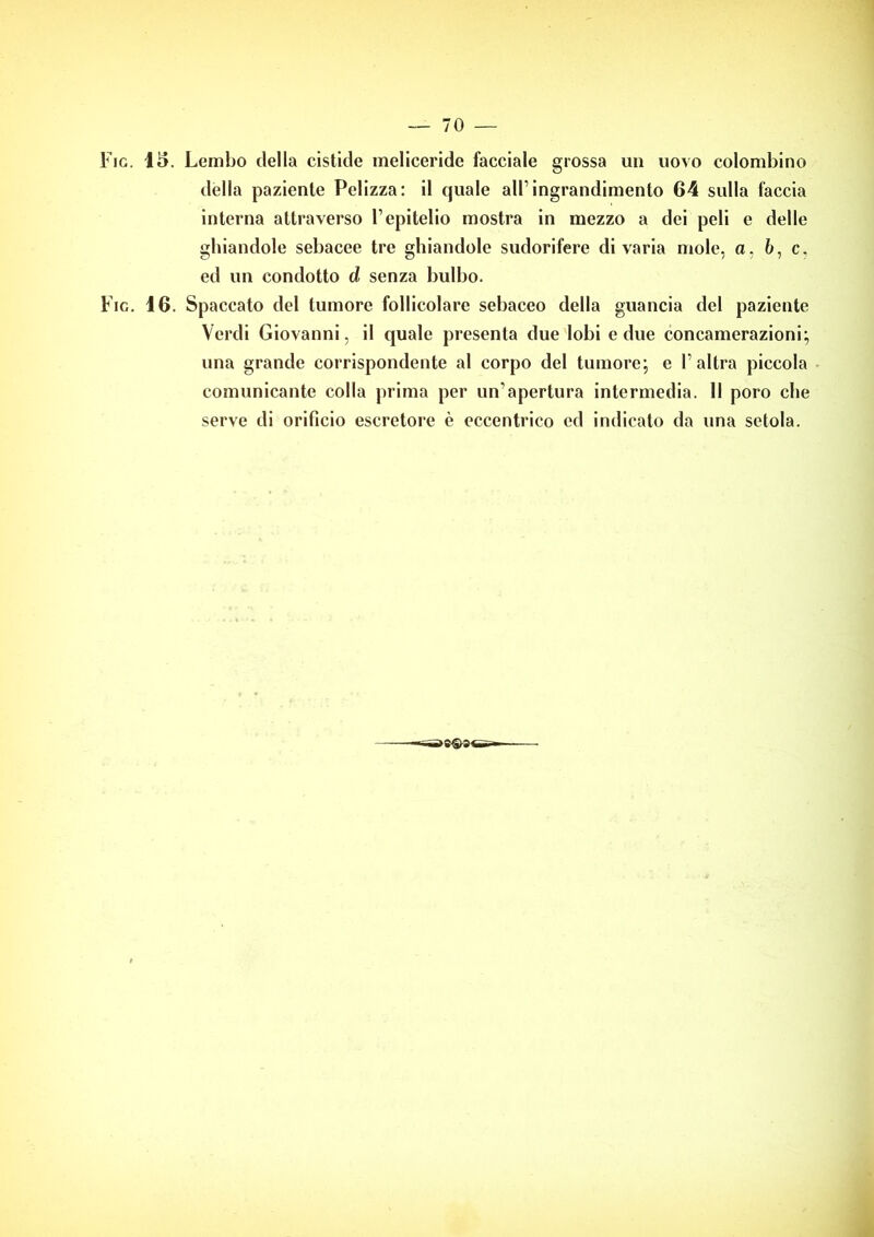 Fig. 1«5. Lembo della cistlde meliceride facciale grossa un novo colombino della paziente Polizza: il quale all’ingrandimento 64 sulla faccia interna attraverso l’epitelio mostra in mezzo a dei peli e delle ghiandole sebacee tre ghiandole sudorifere divaria mole, a, 6, c, ed un condotto d senza bulbo. Fig. 16. Spaccato del tumore follicolare sebaceo della guancia del paziente Verdi Giovanni, il quale presenta due lobi e due concamerazioni; una grande corrispondente al corpo del tumore; e l’altra piccola comunicante colla prima per un’apertura intermedia, li poro che serve di orificio escretore è eccentrico ed indicalo da una setola.