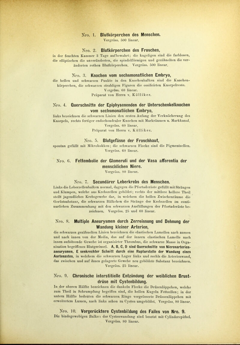 Nro. 1. Blutkörperchen des Menschen. Vergröss. 500 linear. Nro. 2. Blutkörperchen des Frosches, in der feuchten Kammer 3 Tage auf bewahrt; die kugeligen sind die farblosen, die elliptischen die unveränderten, die spindelförmigen und gezähnelten die ver- änderten rotlien Blutkörperchen. Vergröss. 500 linear. Nro. 3. Knochen vom sechsmonatlichen Embryo, die hellen und schwarzen Punkte in den Knochenbalken sind die Knochen- körperchen, die schwarzen strahligen Figuren die ossificirten Knorpelreste. Vergröss. 60 linear. Präparat von Herrn v. Kölliker. Nro. 4. Querschnitte der Epiphysenenden der Unterschenkelknochen vom sechsmonatlichen Embryo, links bezeichnen die schwarzen Linien den ersten Anfang der Verknöcherung des Knorpels, rechts fertiger cndochondrajer Knochen mit Markräumen u. Markkanal. Vergröss. 60 linear. Präparat von Herrn v. K öllik er. Nro. 5. Blutgefässe der Froschhaut, spontan gefüllt mit Mikrokokken; die schwarzen Flecke sind die Pigmentzellen. Vergröss. 60 linear. Nro. 6. Fettembolie der Glomeruli und der Vasa afFerentia der menschlichen Niere. Vergröss. 80 linear. Nro. 7. Secundärer Leberkrebs des Menschen. Links die Leberzellenbalken normal, dagegen die Pfortaderäste gefüllt mit Strängen und Klumpen, welche aus Krebszellen gebildet; rechts der mittlere hellere Theil stellt jugendliches Krebsgewebe dar, in welchem die hellen Zwischenräume die Gerüstsubstanz, die schwarzen Bälkchen die Stränge der Krebszellen im conti- nurlichen Zusammenhang mit den schwarzen Ausfüllungen der Pfortaderäste be- zeichnen. Vergröss. 25 und 60 linear. Nro. 8. Multiple Aneurysmen durch Zerreissung und Dehnung der Wandung kleiner Arterien, die schwarzen gezähnelten Linien bezeichnen die elastischen Lamellen nach aussen und nach innen von der Media, das auf der innern elastischen Lamelle nach innen aufsitzende Gewebe ist organisirter Thrombus, die schwarze Masse in Orga- nisation begriffenes Blutgerinsol. A, B, C, D sind Querschnitte von Nierenarterien- aneurysmen, E senkrechter Schnitt durch eine Rupturstelle der Wandung eines Aortenastes, in welchem die schwarzen Lager links und rechls die Arterienwand, das zwischen und auf ihnen gelagerte Gewebe neu gebildete Substanz bezeichnen. Vergröss. 25 linear. Nro. 9. Chronische interstitielle Entzündung der weiblichen Brust- drüse mit Cystenbildung. In der oberen Hälfte bezeichnen die dunkeln Flecke die Drüsenläppchen, welche zum Theil in Schrumpfung begriffen sind, die hellen Kugeln Fcttzellen; in der untern Hälfte bedeuten die schwarzen Ringe vergrösserte Drüssenläppchen mit erweitertem Lumen, nach links schon zu Cysten umgebildet. Vergröss. 80 linear. Nro. 10. Vorgerücktere Cystenbildung des Falles von Nro. 9. Die bindegewebigen Balken der Cystenwandung sind besetzt mit Cylinderepithel. Vergröss. 80 linear.