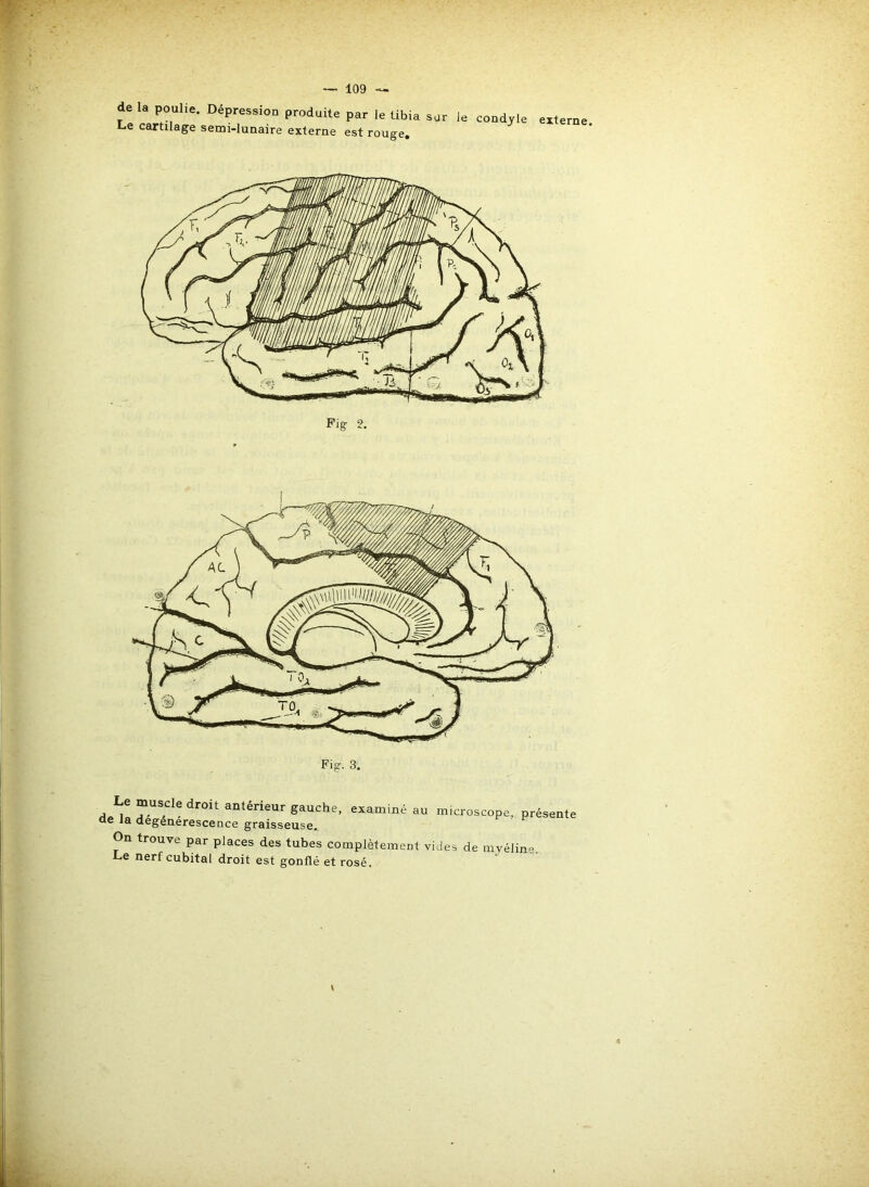 Le muscle droit antérieur gauche, examiné au microscope, préseï ûe la degénerescence graisseuse. On trouve par places des tubes complètement vides de myéline. Le nerf cubital droit est gonflé et rosé. de la poulie. Dépression produite par le tibia sur le condyle Le cartilage semi-lunaire externe est rouge. externe. Fig 2.