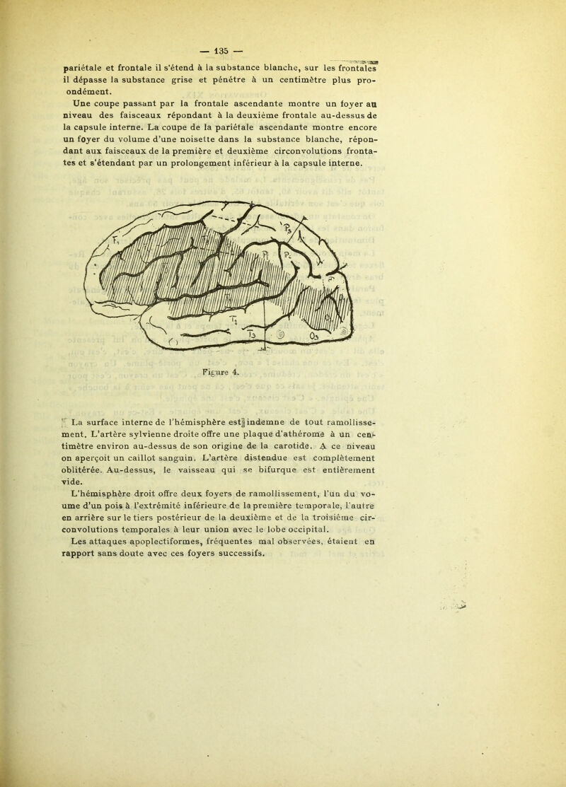 pariétale et frontale il s’étend à la substance blanche, sur les frontales il dépasse la substance grise et pénétre à un centimètre plus pro- ondément. Une coupe passant par la frontale ascendante montre un foyer au niveau des faisceaux répondant à la deuxième frontale au-dessus de la capsule interne. La coupe de la pariétale ascendante montre encore un foyer du volume d’une noisette dans la substance blanche, répon- dant aux faisceaux de la première et deuxième circonvolutions fronta- tes et s’étendant par un prolongement inférieur à la capsule interne. La surface interne de l’hémisphère est| indemne de tout ramollisse- ment. L’artère sylvienne droite offre une plaque d’athérome à un cen- timètre environ au-dessus de son origine de la carotide. A ce niveau on aperçoit un caillot sanguin. L’artère distendue est complètement oblitérée. Au-dessus, le vaisseau qui se bifurque est entièrement vide. L’hémisphère droit offre deux foyers de ramollissement, l’un du vo- ume d’un pois à l’extrémité inférieure de la première temporale, l’autre en arrière sur le tiers postérieur de la deuxième et de la troisième cir- convolutions temporales à leur union avec le lobe occipital. Les attaques apoplectiformes, fréquentes mal observées, étaient en rapport sans doute avec ces foyers successifs.
