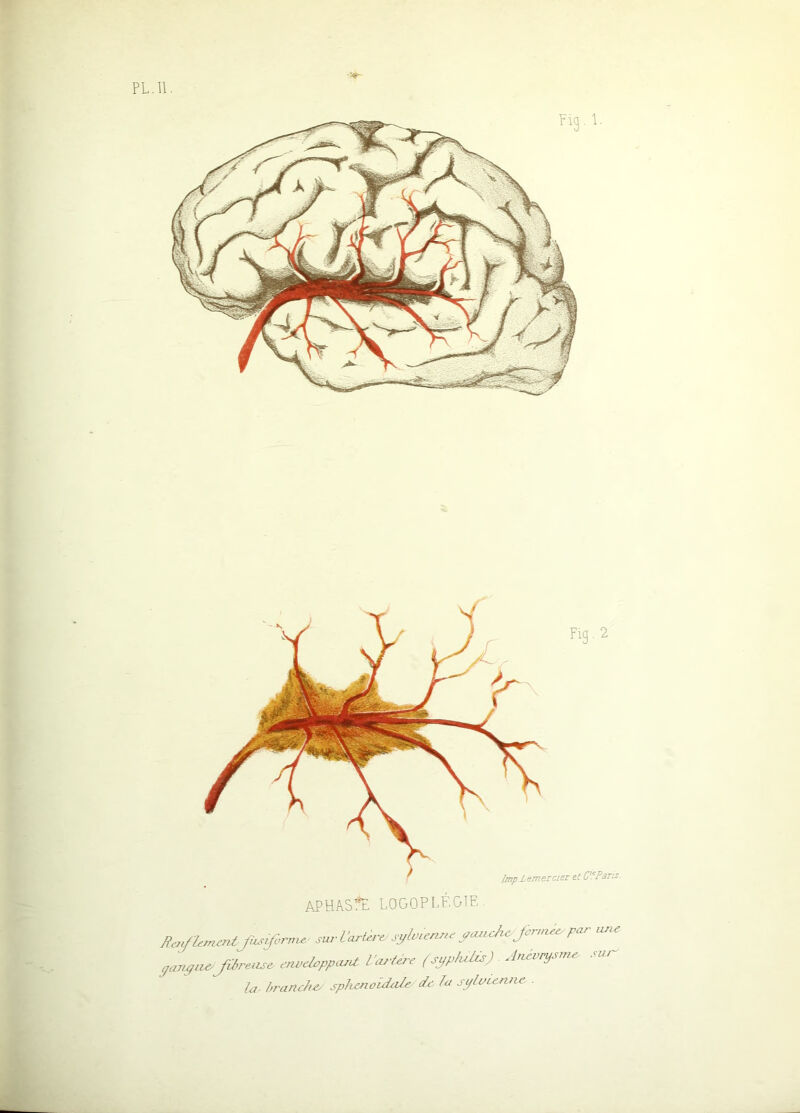 PL.11. lmp Lemeiciei et (PlPans. APHASPl LOGOPLÉGIE. s.rVarl.,r sÿl.un,.. yauch. P-- yay!yii€'Jïtreuse emjdcppaïU. L'ai-tere {jyp/ulù) Aiievrystn^ la- h'anch-o .sphenoidcde de la sylaceniie .