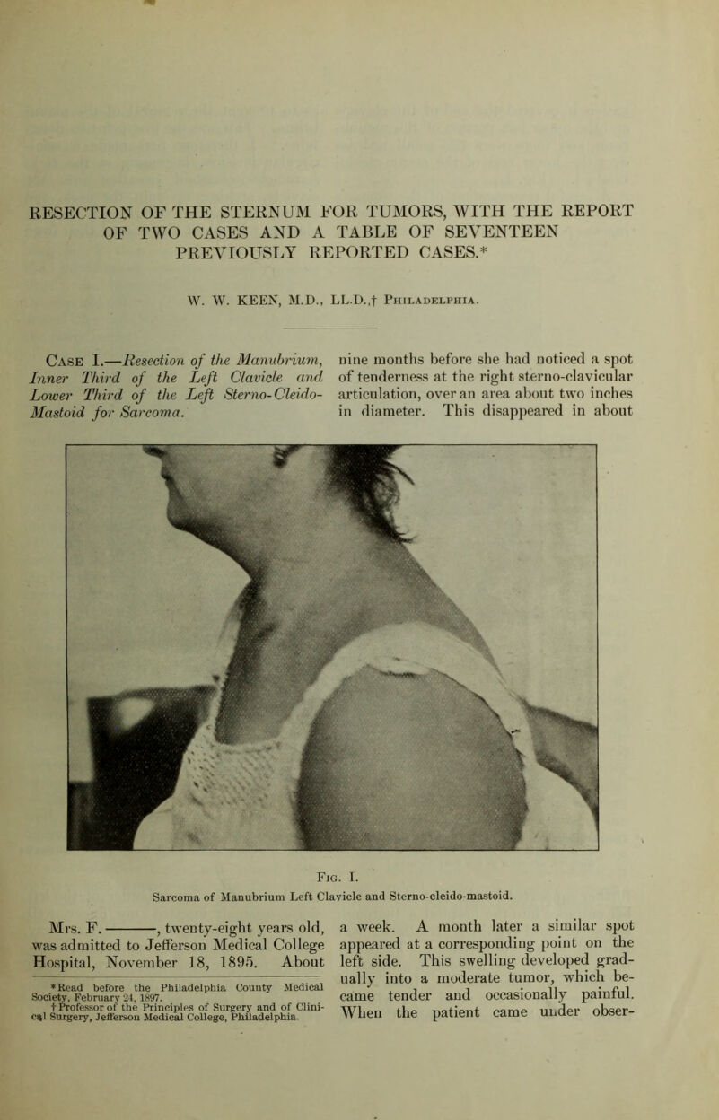 RESECTION OF THE STERNUM FOR TUMORS, WITH THE REPORT OF TWO CASES AND A TABLE OF SEVENTEEN PREVIOUSLY REPORTED CASES.* W. W. KEEN, M.D., LL.D.,f Philadelphia. Case I.—Resection of the Manubrium, nine months before she had noticed a spot Inner Third of the Left Clavicle and of tenderness at the right sterno-clavicular Lower Third of the Left Sterno-Cleido- articulation, over an area about two inches Mastoid for Sarcoma. in diameter. This disappeared in about Fig. I. Sarcoma of Manubrium Left Clavicle and Sterno-cleido-mastoid. Mrs. F. , twenty-eight years old, was admitted to Jefferson Medical College Hospital, November 18, 1895. About ♦Read before the Philadelphia County Medical Society, February 24, 1897. t Professor of the Principles of Surgery and of Clini- cal Surgery, Jefferson Medical College, Philadelphia a week. A month later a similar spot appeared at a corresponding point on the left side. This swelling developed grad- ually into a moderate tumor, which be- came tender and occasionally painful. When the patient came under obser-