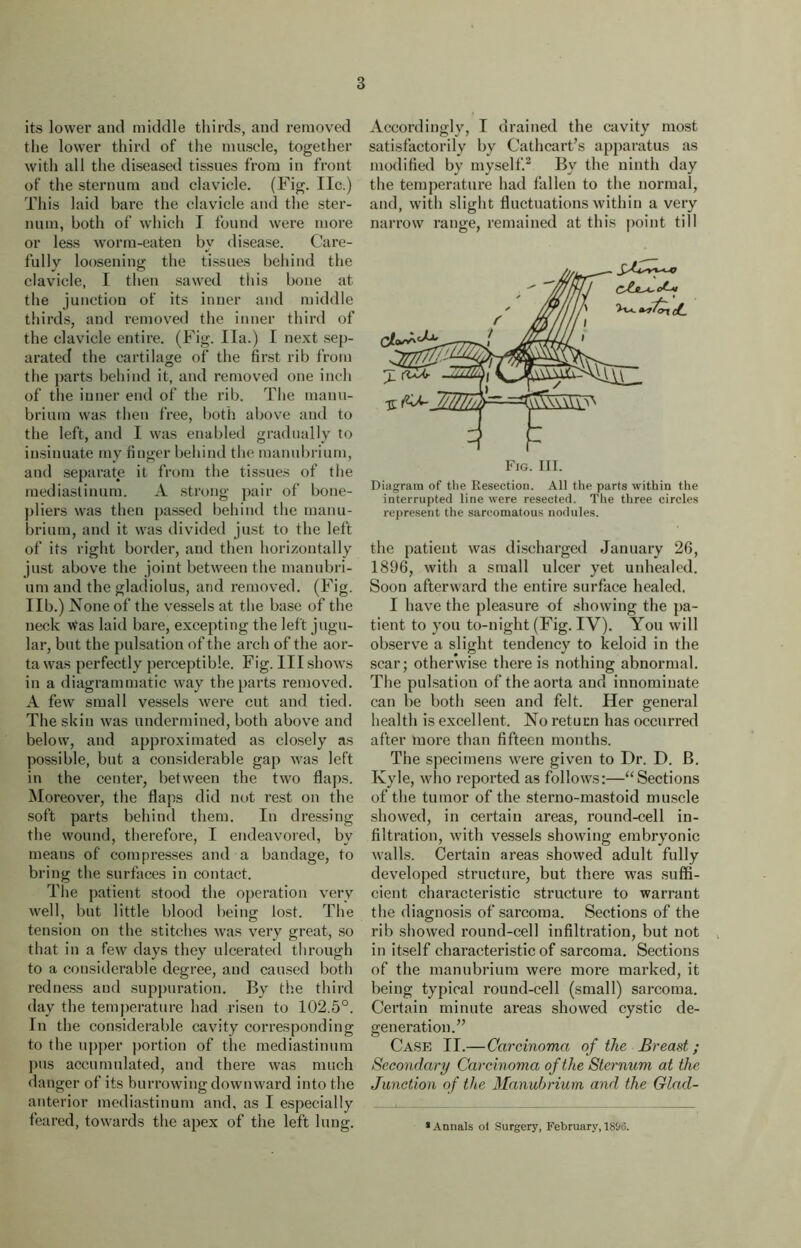 its lower and middle thirds, and removed the lower third of the muscle, together with all the diseased tissues from in front of the sternum and clavicle. (Fig. lie.) This laid bare the clavicle and the ster- num, both of which I found were more or less worm-eaten by disease. Care- fully loosening the tissues behind the clavicle, I then sawed this bone at the junction of its inner and middle thirds, and removed the inner third of the clavicle entire. (Fig. Ila.) I next sep- arated the cartilage of the first rib from the parts behind it, and removed one inch of the inner end of the rib. The manu- brium was then free, both above and to the left, and I was enabled gradually to insinuate my finger behind the manubrium, and separate it from the tissues of the mediastinum. A strong pair of bone- pliers was then passed behind the manu- brium, and it was divided just to the left of its right border, and then horizontally just above the joint between the manubri- um and the gladiolus, and removed. (Fig. lib.) None of the vessels at the base of the neck Was laid bare, excepting the left jugu- lar, but the pulsation of the arch of the aor- ta was perfectly perceptible. Fig. Ill shows in a diagrammatic way the parts removed. A few small vessels were cut and tied. The skin was undermined, both above and below, and approximated as closely as possible, but a considerable gap was left in the center, between the two flaps. Moreover, the flaps did not rest on the soft parts behind them. In dressing the wound, therefore, I endeavored, by means of compresses and a bandage, to bring the surfaces in contact. The patient stood the operation very well, but little blood being lost. The tension on the stitches was very great, so that in a few days they ulcerated through to a considerable degree, and caused both redness and suppuration. By the third day the temperature had risen to 102.5°. In the considerable cavity corresponding to the upper portion of the mediastinum pus accumulated, and there was much danger of its burrowing downward into the anterior mediastinum and, as I especially feared, towards the apex of the left lung. Accordingly, I drained the cavity most satisfactorily by Cathcart’s apparatus as modified by myself.2 By the ninth day the temperature had fallen to the normal, and, with slight fluctuations within a very narrow range, remained at this point till Diagram of the Resection. All the parts within the interrupted line were resected. The three circles represent the sarcomatous nodules. the patient was discharged January 26, 1896, with a small ulcer yet unhealed. Soon afterward the entire surface healed. I have the pleasure of showing the pa- tient to you to-night (Fig. IV). You will observe a slight tendency to keloid in the scar; otherwise there is nothing abnormal. The pulsation of the aorta and innominate can be both seen and felt. Her general health is excellent. No return has occurred after more than fifteen months. The specimens were given to Dr. D. B. Kyle, who reported as follows:—“Sections of the tumor of the sterno-mastoid muscle showed, in certain areas, round-cell in- filtration, with vessels showing embryonic walls. Certain areas showed adult fully developed structure, but there was suffi- cient characteristic structure to warrant the diagnosis of sarcoma. Sections of the rib showed round-cell infiltration, but not in itself characteristic of sarcoma. Sections of the manubrium were more marked, it being typical round-cell (small) sarcoma. Certain minute areas showed cystic de- generation. Case II.—Carcinoma of the Breast; Secondary Carcinoma of the Sternum at the Junction of the Manubrium and the Glad- • Annals ol Surgery, February, 1896.