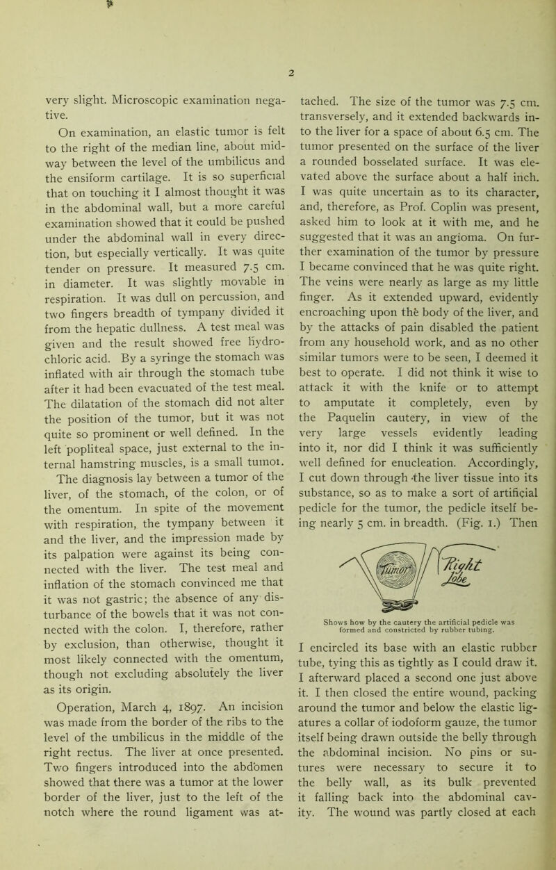 * very slight. Microscopic examination nega- tive. On examination, an elastic tumor is felt to the right of the median line, about mid- way between the level of the umbilicus and the ensiform cartilage. It is so superficial that on touching it I almost thought it was in the abdominal wall, but a more careful examination showed that it could be pushed under the abdominal wall in every direc- tion, but especially vertically. It was quite tender on pressure. It measured 7.5 cm. in diameter. It was slightly movable in respiration. It was dull on percussion, and two fingers breadth of tympany divided it from the hepatic dullness. A test meal was given and the result showed free hydro- chloric acid. By a syringe the stomach was inflated with air through the stomach tube after it had been evacuated of the test meal. The dilatation of the stomach did not alter the position of the tumor, but it was not quite so prominent or well defined. In the left popliteal space, just external to the in- ternal hamstring muscles, is a small tumoi. The diagnosis lay between a tumor of the liver, of the stomach, of the colon, or of the omentum. In spite of the movement with respiration, the tympany between it and the liver, and the impression made by its palpation were against its being con- nected with the liver. The test meal and inflation of the stomach convinced me that it was not gastric; the absence of any dis- turbance of the bowels that it was not con- nected with the colon. I, therefore, rather by exclusion, than otherwise, thought it most likely connected with the omentum, though not excluding absolutely the liver as its origin. Operation, March 4, 1897. An incision was made from the border of the ribs to the level of the umbilicus in the middle of the right rectus. The liver at once presented. Two fingers introduced into the abdomen showed that there was a tumor at the lower border of the liver, just to the left of the notch where the round ligament was at- tached. The size of the tumor was 7.5 cm. transversely, and it extended backwards in- to the liver for a space of about 6.5 cm. The tumor presented on the surface of the liver a rounded bosselated surface. It was ele- vated above the surface about a half inch. I was quite uncertain as to its character, and, therefore, as Prof. Coplin was present, asked him to look at it with me, and he suggested that it was an angioma. On fur- ther examination of the tumor by pressure I became convinced that he was quite right. The veins were nearly as large as my little finger. As it extended upward, evidently encroaching upon the body of the liver, and by the attacks of pain disabled the patient from any household work, and as no other similar tumors were to be seen, I deemed it best to operate. I did not think it wise to attack it with the knife or to attempt to amputate it completely, even by the Paquelin cautery, in view of the very large vessels evidently leading into it, nor did I think it was sufficiently well defined for enucleation. Accordingly, I cut down through -the liver tissue into its substance, so as to make a sort of artificial pedicle for the tumor, the pedicle itself be- ing nearly 5 cm. in breadth. (Fig. 1.) Then Shows how by the cautery the artificial pedicle was formed and constricted by rubber tubing. I encircled its base with an elastic rubber tube, tying this as tightly as I could draw it. I afterward placed a second one just above it. I then closed the entire wound, packing around the tumor and below the elastic lig- atures a collar of iodoform gauze, the tumor itself being drawn outside the belly through the abdominal incision. No pins or su- tures were necessary to secure it to the belly wall, as its bulk prevented it falling back into the abdominal cav- ity. The wound was partly closed at each