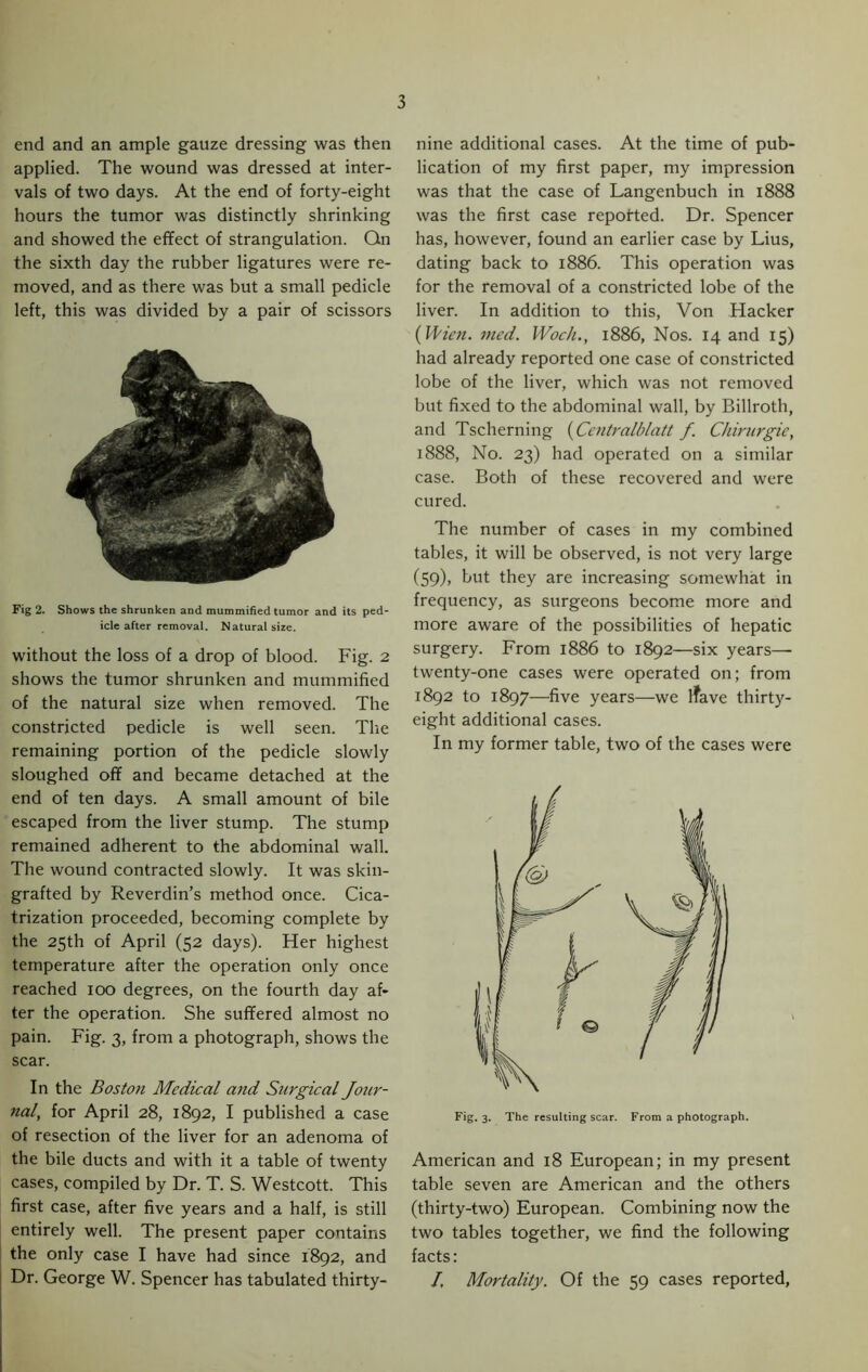 end and an ample gauze dressing was then applied. The wound was dressed at inter- vals of two days. At the end of forty-eight hours the tumor was distinctly shrinking and showed the effect of strangulation. Qn the sixth day the rubber ligatures were re- moved, and as there was but a small pedicle left, this was divided by a pair of scissors Fig 2. Shows the shrunken and mummified tumor and its ped- icle after removal. Natural size. without the loss of a drop of blood. Fig. 2 shows the tumor shrunken and mummified of the natural size when removed. The constricted pedicle is well seen. The remaining portion of the pedicle slowly sloughed off and became detached at the end of ten days. A small amount of bile escaped from the liver stump. The stump remained adherent to the abdominal wall. The wound contracted slowly. It was skin- grafted by Reverdin’s method once. Cica- trization proceeded, becoming complete by the 25th of April (52 days). Her highest temperature after the operation only once reached 100 degrees, on the fourth day af- ter the operation. She suffered almost no pain. Fig. 3, from a photograph, shows the scar. In the Bosto?i Medical and Surgical Jour- nal, for April 28, 1892, I published a case of resection of the liver for an adenoma of the bile ducts and with it a table of twenty cases, compiled by Dr. T. S. Westcott. This first case, after five years and a half, is still entirely well. The present paper contains the only case I have had since 1892, and Dr. George W. Spencer has tabulated thirty- nine additional cases. At the time of pub- lication of my first paper, my impression was that the case of Langenbuch in 1888 was the first case reported. Dr. Spencer has, however, found an earlier case by Lius, dating back to 1886. This operation was for the removal of a constricted lobe of the liver. In addition to this, Von Hacker (Wien. med. Woch., 1886, Nos. 14 and 15) had already reported one case of constricted lobe of the liver, which was not removed but fixed to the abdominal wall, by Billroth, and Tscherning (Centralblatt f. Chirurgie, 1888, No. 23) had operated on a similar case. Both of these recovered and were cured. The number of cases in my combined tables, it will be observed, is not very large (59), but they are increasing somewhat in frequency, as surgeons become more and more aware of the possibilities of hepatic surgery. From 1886 to 1892—six years— twenty-one cases were operated on; from 1892 to 1897—five years—we ifave thirty- eight additional cases. In my former table, two of the cases were Fig. 3. The resulting scar. From a photograph. American and 18 European; in my present table seven are American and the others (thirty-two) European. Combining now the two tables together, we find the following facts: I. Mortality. Of the 59 cases reported,