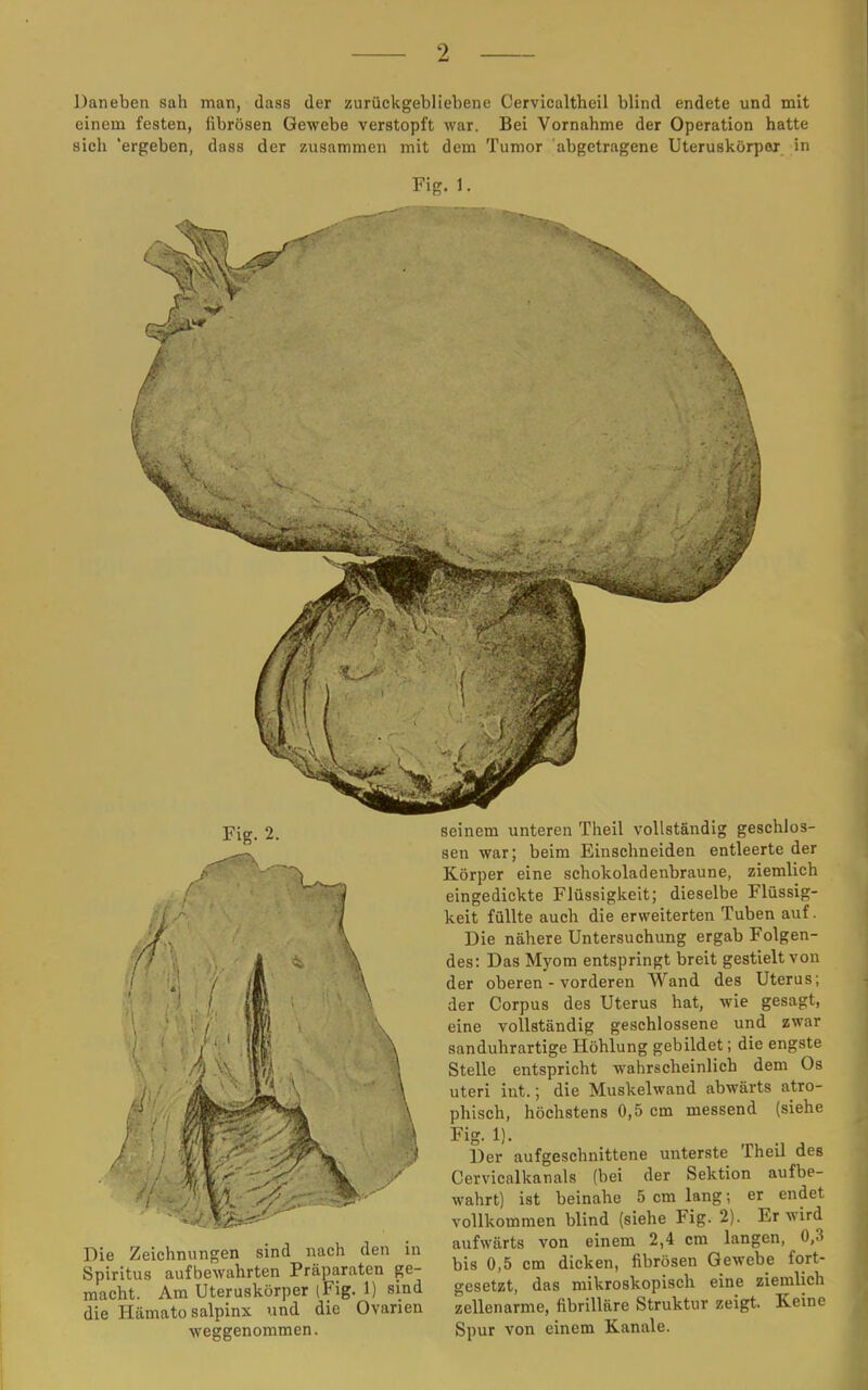 Daneben sah man, dass der zurückgebliebene Cervicaltheil blind endete und mit einem festen, fibrösen Gewebe verstopft war. Bei Vornahme der Operation hatte sich 'ergeben, dass der zusammen mit dem Tumor abgetragene Uteruskörpor in Fig. 1. Fig. 2. Die Zeichnungen sind nach den in Spiritus aufbewahrten Präparaten ge- macht. Am Uteruskörper (Fig. 1) sind die Hämato Salpinx und die Ovarien weggenommen. seinem unteren Theil vollständig geschlos- sen war; beim Einschneiden entleerte der Körper eine schokoladenbraune, ziemlich eingedickte Flüssigkeit; dieselbe Flüssig- keit füllte auch die erweiterten Tuben auf. Die nähere Untersuchung ergab Folgen- des: Das Myom entspringt breit gestielt von der oberen - vorderen Wand des Uterus; der Corpus des Uterus hat, wie gesagt, eine vollständig geschlossene und zwar sanduhrartige Höhlung gebildet; die engste Stelle entspricht wahrscheinlich dem Os uteri int.; die Muskelwand abwärts atro- phisch, höchstens 0,5 cm messend (siehe Fig. 1). Der aufgeschnittene unterste Theil des Cervicalkanals (bei der Sektion aufbe- wahrt) ist beinahe 5 cm lang; er endet vollkommen blind (siehe Fig. 2). Er wird aufwärts von einem 2,4 cm langen, 0,3 bis 0,5 cm dicken, fibrösen Gewebe fort- gesetzt, das mikroskopisch eine ziemlich zellenarme, fibrilläre Struktur zeigt. Keine Spur von einem Kanäle.