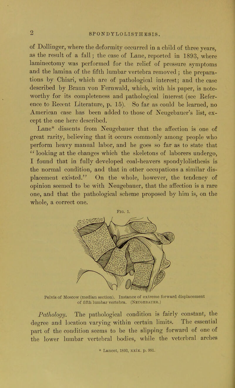 of Dolliuger, where the deformity occurred in a child of three years, as the result of a fall; the case of Lane, reported in 1893, where laminectomy was performed for the relief of pressure symptoms and the lamina of the fifth lumbar vertebra removed; the prepara- tions by Chiari, which are of pathological interest; and the case described by Braun von Feruwald, which, with his paper, is note- worthy for its completeness and pathological interest (see Refer- ence to Recent Literature, p. 15). So far as could be learned, no American case has been added to those of Neugebauer's list, ex- cept the one here described. Lane* dissents from Neugebauer that the affection is one of great rarity, believing that it occurs commonly among people who perform heavy manual labor, and he goes so far as to state that  looking at the changes which the skeletons of laborers undergo, I found that in fully developed coal-heavers spondylolisthesis is the normal condition, and that in other occupations a similar dis- placement existed. On the whole, however, the tendency of opinion seemed to be with Neugebauer, that the affection is a rare one, and that the pathological scheme proposed by him is, on the whole, a correct one. Fig. 1. Pelvis of Moscow (median section). Instance of extreme forward displacement of fifth lumbar vertebra. (Neugebauer.) Pathology. The pathological condition is fairly constant, the degree and location varying within certain limits. The essential part of the condition seems to be the slipping forward of one of the lower lumbar vertebral bodies, while the veterbral arches * Lancet, 1893, xxix. p. 991.