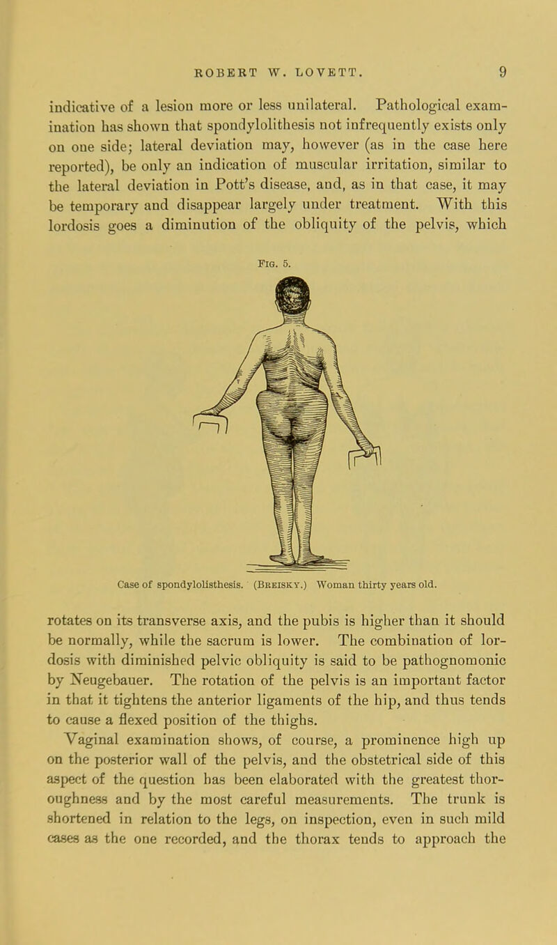 indicative of a lesion more or less unilateral. Pathological exam- ination has shown that spondylolithesis not infrequently exists only on one side; lateral deviation may, however (as in the case here reported), be only an indication of muscular irritation, similar to the lateral deviation in Pott's disease, and, as in that case, it may be temporary and disappear largely under treatment. With this lordosis goes a diminution of the obliquity of the pelvis, which Fig. 5. Case of spondylolisthesis. (Breisky.) Woman thirty years old. rotates on its transverse axis, and the pubis is higher than it should be normally, while the sacrum is lower. The combination of lor- dosis with diminished pelvic obliquity is said to be pathognomonic by Neugebauer. The rotation of the pelvis is an important factor in that it tightens the anterior ligaments of the hip, and thus tends to cause a flexed position of the thighs. Vaginal examination shows, of course, a prominence high up on the posterior wall of the pelvis, and the obstetrical side of this aspect of the question has been elaborated with the greatest thor- oughness and by the most careful measurements. The trunk is shortened in relation to the legs, on inspection, even in such mild cases as the one recorded, and the thorax tends to approach the