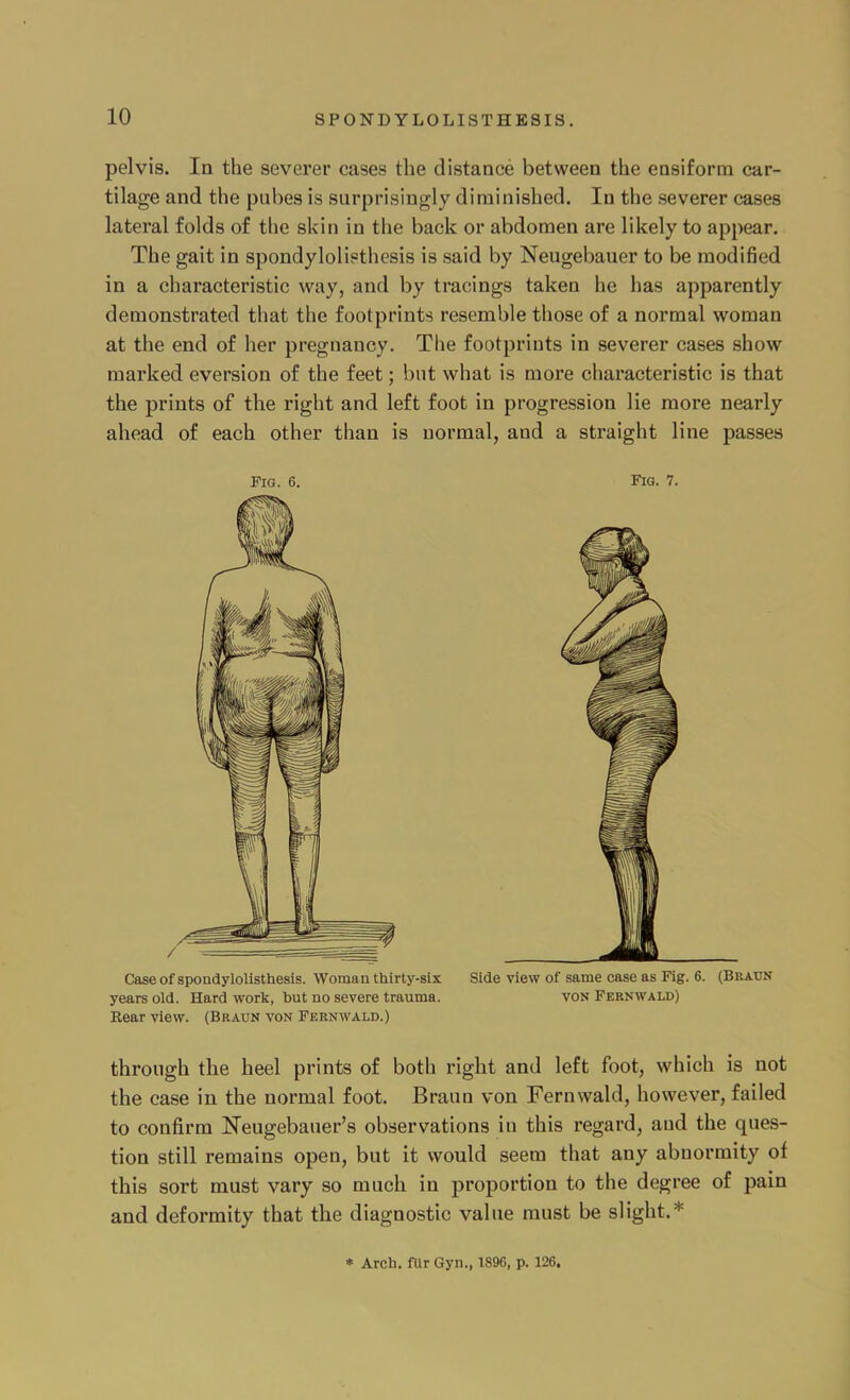 pelvis. In the severer cases the distance between the ensiform car- tilage and the pubes is surprisingly diminished. In the severer cases lateral folds of the skin in the back or abdomen are likely to appear. The gait in spondylolisthesis is said by Neugebauer to be modified in a characteristic way, and by tracings taken he has apparently demonstrated that the footprints resemble those of a normal woman at the end of her pregnancy. The footprints in severer cases show marked eversion of the feet; but what is more characteristic is that the prints of the right and left foot in progression lie more nearly ahead of each other than is normal, and a straight line passes Fig. 6. Fig. 7. Case of spondylolisthesis. Woman thirty-six Side view of same case as Fig. 6. (Braun years old. Hard work, but no severe trauma. von Fernwald) Rear view. (Braun von Fernwald.) through the heel prints of both right and left foot, which is not the case in the normal foot. Braun von Fernwald, however, failed to confirm Neugebauer's observations in this regard, and the ques- tion still remains open, but it would seem that any abnormity of this sort must vary so much in proportion to the degree of pain and deformity that the diagnostic value must be slight.* * Arch, fllr Gyn., 1896, p. 126.