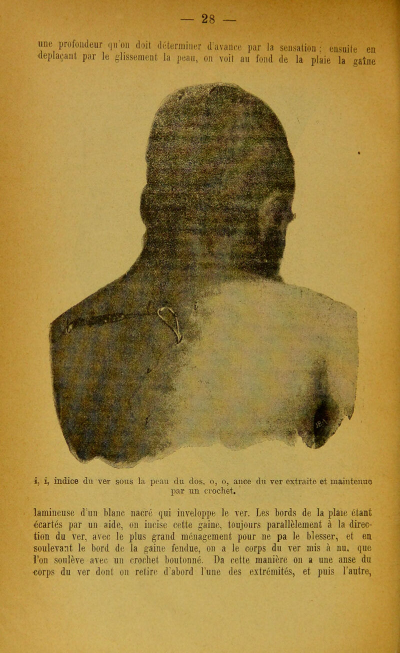 une profondeur qu'on doit déterminer d'avance par la sensation : ensuite déplaçant par le glissement la peau, on voit au fond de la plaie la gai i, i, indice du ver sous la peau du dos. o, o, ance du ver extraite et maintenue par un crochet. lamineuse d'un blanc nacré qui invcloppe le ver. Les bords de la plaie étant écartés par un aide, on incise cette gaine, toujours parallèlement à la direc- tion du ver, avec le plus grand ménagement pour ne pa le blesser, et eu soulevant le bord de la gaine fendue, on a le corps du ver mis à nu, que l'on soulève avec, un crochet boutonné. Da cette manière on a une anse du «orps du ver dont on retire d*abord l'une des extrémités, et puis l'autre,