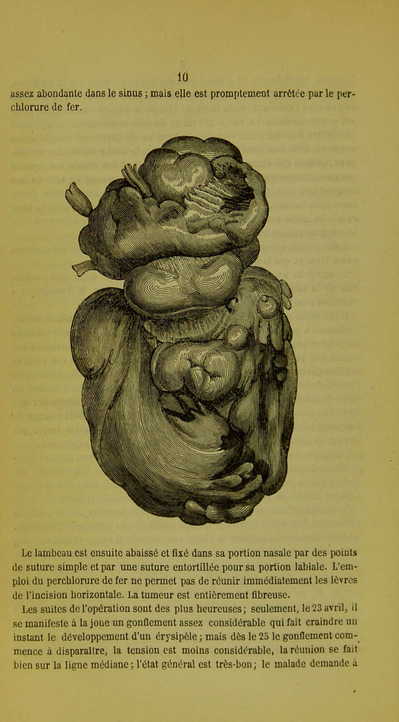 assez abondante dans le sinus ; mais elle est promptement arrêtée par le per- chlorure de fer. Le lambeau est ensuite abaissé et fixé dans sa portion nasale par des poiuts de suture simple et par une suture entortillée pour sa portion labiale. L'em- ploi du percblorure de fer ne permet pas de réunir immédiatement les lèvres de l'incision borizontale. La tumeur est entièrement fibreuse. Les suites de l'opération sont des plus heureuses; seulement, le 23 avril, il se manifeste à la joue un gonflement assez considérable qui fait craindre un instant le développement d'un érysipèle ; mais dès le 25 le gonflement com- mence à disparaître, la tension est moins considérable, la réunion se fait bien sur la ligne médiane ; l'état général est très-bon; le malade demande ù