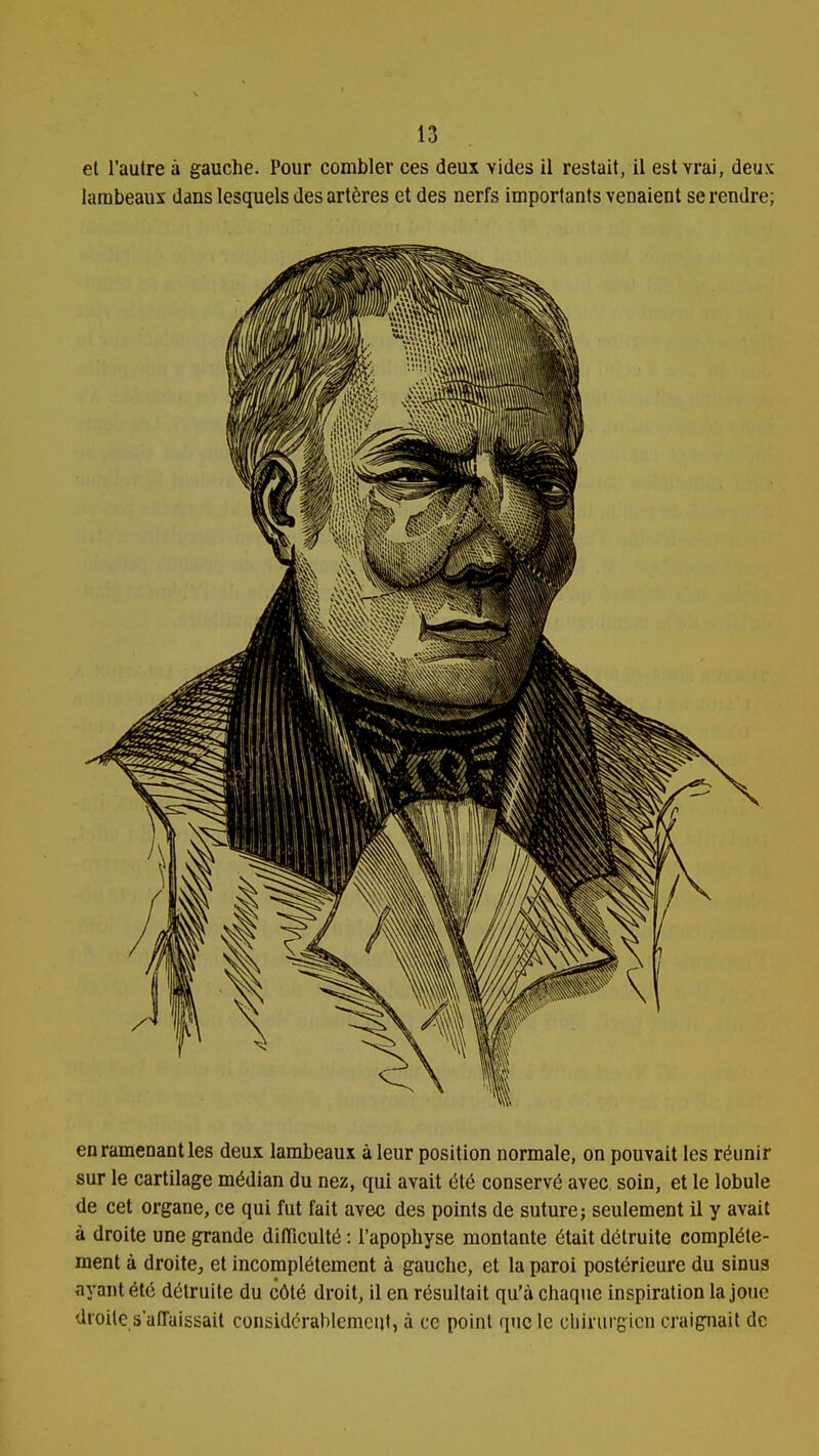 el l'autre à gauche. Pour combler ces deux vides il restait, il est vrai, deux lambeaux dans lesquels des artères et des nerfs importants venaient se rendre; en ramenant les deux lambeaux à leur position normale, on pouvait les réunir sur le cartilage médian du nez, qui avait été conservé avec soin, et le lobule de cet organe, ce qui fut fait avec des points de suture; seulement il y avait à droite une grande difficulté : l'apophyse montante était détruite complète- ment à droite, et incomplètement à gauche, et la paroi postérieure du sinus ayant été détruite du côté droit, il en résultait qu'à chaque inspiration la joue droite s'affaissait considérablement, à ce point que le chirurgien craignait de